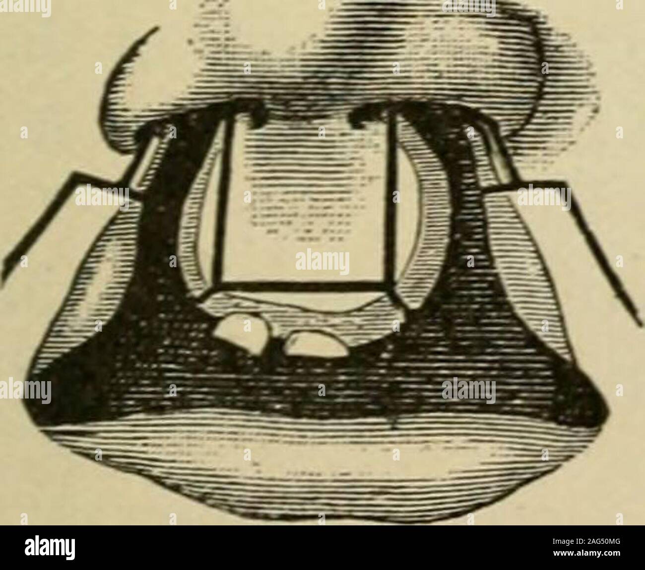 . Manuel de chirurgie opératoire. FiG. 205. Fig. 206. tion des bords de la fente au-dessous du niveau de la partie centrale (G). Le twolower les volets lorsque leurs matières surfaces sont suturés ensemble forment une proéminence sur le bord de la nouvelle lèvre supérieure. L'apparition de la blessure quand l'opéra-tion est terminé est représenté à la Fig. 206. D'autres méthodes d'exploitation d'aresuflSciently illustré par les figues. 207 à 215.. Banque D'Images