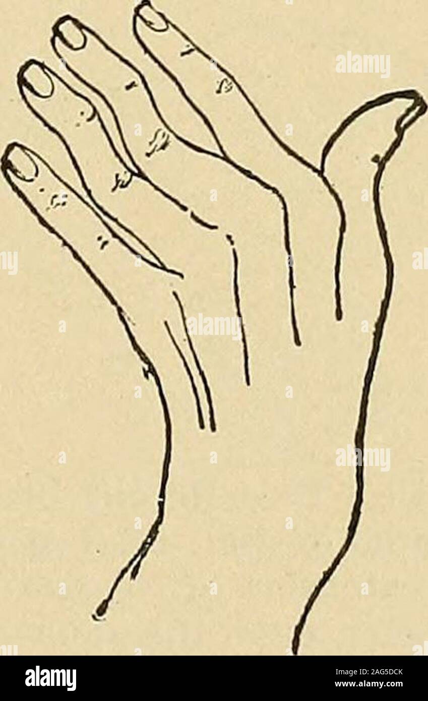 . Un manuel des maladies du système nerveux. Fig. 13.-l'attitude de la part de la contraction de l'aponévrose palmaire, resemblingthat dans la paralysie du long extenseurs des doigts. Fig. 14. - Paralysie des fibres du muscle sublimis qui agissent sur l'twomiddle les doigts : douze ans la durée. La deuxième de ces phalanges et subluxated fingersare repliées vers l'arrière de la contracture de l'unopposedinterossei plialanges, tandis que le dernier est maintenu en position par le unaffectedflexor profundus. (Après la myopathie.) Lorsque le muscle extenseur des doigts est dans une action forte, l'extension de l'proximalphalanges, Banque D'Images