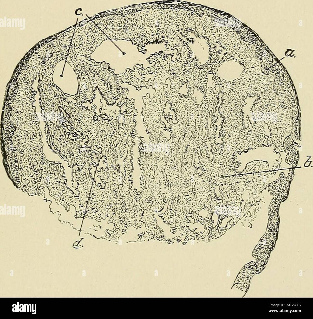 . Pathologie gynécologique ; un manuel de technique microscopique et au diagnostic dans la pratique gynécologique, pour les étudiants et les médecins. des polypes peuvent être distinguées dans l'inal vag-partie de l'utérus : 1. Polypes provenant de la surface de l'épithélium malpighien de l'extérieur de l'utérus. 2. Ceux qui sont formés à la jonction de l'épithélioma malpighien spinocellulaire de cyl-indrical épithélium. Les polypes cervicaux. 53 3. Ceux qui partent dans le canal cervical et, par conséquent, d'une surface couverte entièrement avec l'épithélium cylindrique. Selon son origine comme un polype cervical a comme revêtement squa-protocoles d'épithélium ou Banque D'Images