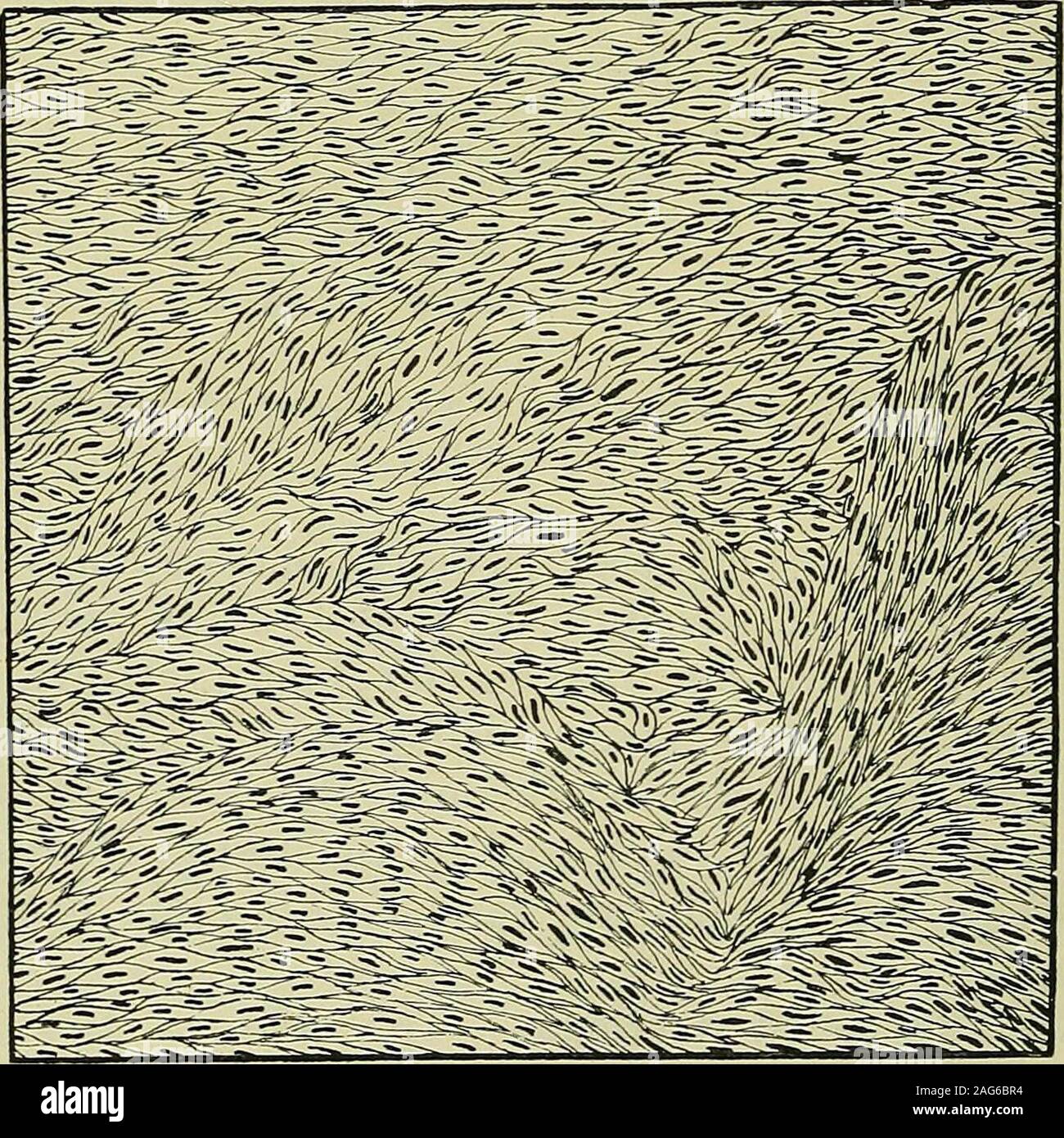 . Les tumeurs, malignes et innocentes ; leurs caractères cliniques et le traitement approprié. Fig. 35.-caractères microscopiques d'une petite fusée-celled kaposi d métacarpe. Dans certains sarcomes les cellules sont si minces et contiennent des solittle protoplasme qu'ils semblent comprendre qu'un noyau. Fig. 36.-Section d'une fusée-celled kaposi à partir de la première phalange du pouce.{Sighly, grossie) et cell-processus. Dans d'autres, les cellules sont grandes, fusiformes, andrich protoplasme, dans les cellules et ressemblent à de jeunes unstriped de sarcomes 55 muscle. Parfois, ces cellules sont transverselystri la fusée Banque D'Images