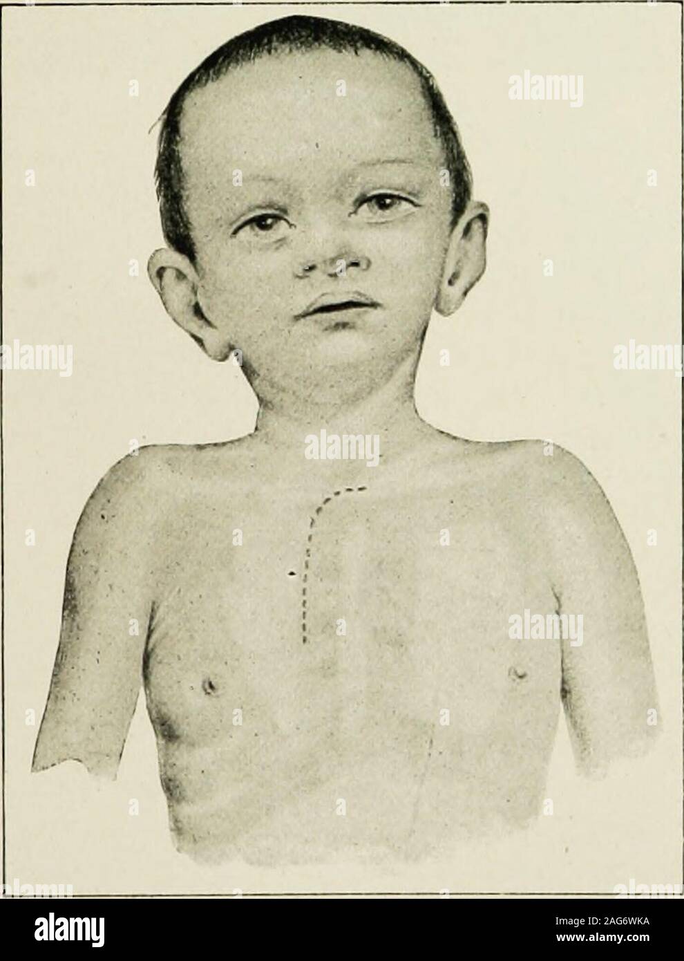 . Les maladies de l'enfance et l'enfance : conçu pour l'utilisation d'étudiants et de praticiens de la médecine. Fio. 159.-cavité pleurale rempli de liquide.l'avant et à l'homogénéité. F7G. 160.-cavité pleurale remplie. withfluid Personnes déplacées vers le haut et de poumon. Plus theapex la résonance en avant, l'autre vesiculotympanitic thecracked ou de pot-qunlity.. Information prospective. Itil.-Déplacement de la plèvre gauche plier en épanchement (empyème) dans thepleural la planéité de la cavité ; à droite de l'midsternum comme indiqué. gauche 638 LES MALADIES DU SYSTÈME RESPIRATOIRE Banque D'Images