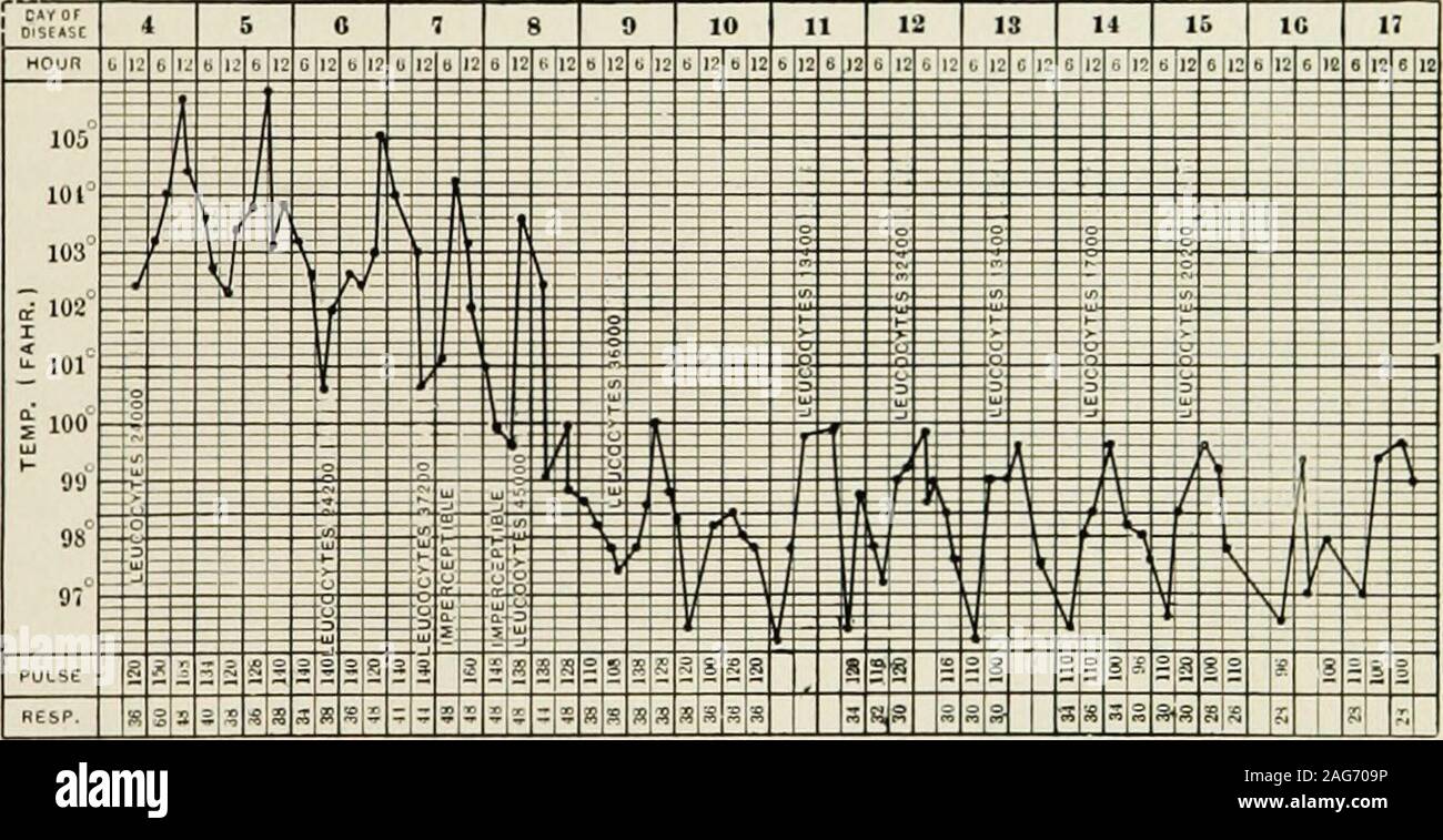 . Les maladies de l'enfance et l'enfance : conçu pour l'utilisation d'étudiants et de praticiens de la médecine. Fig. 142.-pneumonie lobaire, poumon droit, lobe moyen d'épanchement ; dans la plèvre. Température-Tem après crise due à une pleurésie. Garçon, âgé de huit ans. lysis commence le septième ou huitième jour, et s'achève twoor trois jours. De 57 cas de pneumonie lobaire dans laquelle une reliablehistory pourrait être obtenue, la température a chuté de crise en 36 et lorsque lysis dans 21 cas. La crise, en règle générale, se produit à partir du cinquième au neuvième jour de la maladie (60  % des cas, ma). Après la. Fig. 143.-lobaires Banque D'Images