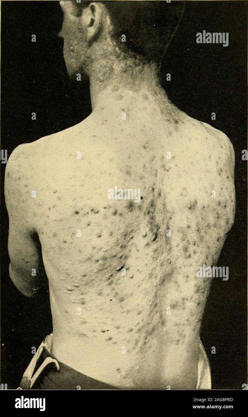 . Un traité pratique sur les maladies de la peau, à l'usage des étudiants et des praticiens. n de l'épiderme de thisregion, précisément comme dans f actinique. Certains auteurs français par l'État est considéré comme un stade précoce de l'actinique (psorospermosis)folliculaire. Keloid-Acne papillitii dermatite [capillaris] est un nom whichhas été accordée à une folliculite inflammatoire et partie perifolliculitis, ing-infiltrations profondes, généralement, dans l'épiderme épais sur le neckand l'arrière de l'agrégation, même si vu également sur le cuir chevelu et le visage.brins d'épais, déformé, et évidemment modifié les cheveux en proj Banque D'Images