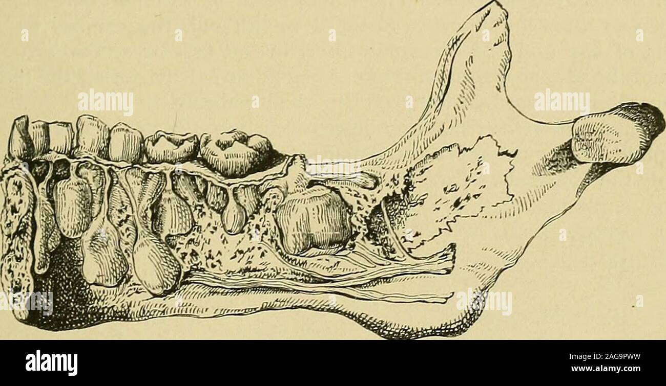 . Les maladies de l'enfance : services médicaux et chirurgicaux. ecomes plus vasculaire, le bord de la dent apparaît comme une ligne ou pointl)eneath la membrane, qui devient finalement perforés, et la dent est coupé. L'ensemble temporaire apparaissent la plupart du temps en groupes dans le followingorder. Premier groupe-Les deux incisives centrales apparaissent à partir de la 6ème 8thmonth, suivie d'une pause de trois à six semaines. Deuxième groupe-Thefour les incisives supérieures sont coupés à des intervalles d'une semaine ou deux, à partir de la 8ème-iothmonth, suivie d'un intervalle de un à trois mois. Tbird group-Lavis incisives latérales, la haute et basse Banque D'Images