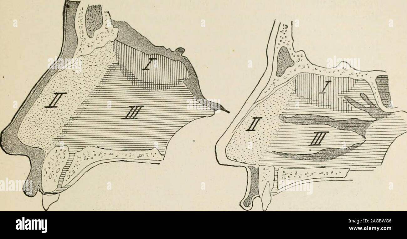 . L'anesthésie locale et régionale ; avec des chapitres sur la moelle, péridurale, et l'analgésie paravertébrale, parasacral, et d'autres applications de l'anesthésie locale et régionale pour la chirurgie de l'œil, des oreilles, du nez et de la gorge, et à la pratique dentaire. palatine s branchtonsillar ^j'art" br. 1^ viihiite, papilles multilingues. folliclespalatine J'amygdales ?, mandibule X dos de langue ^sotinas palatin art.ant. nerf palatin Fig 247 -Les nerfs et les artères de la face externe de la paroi du nez et de la bouche. Thetongue a été tiré, l'ensemble de la cloison nasale à l'exception de sa partie inférieure, et la membrane muqueuse o Banque D'Images