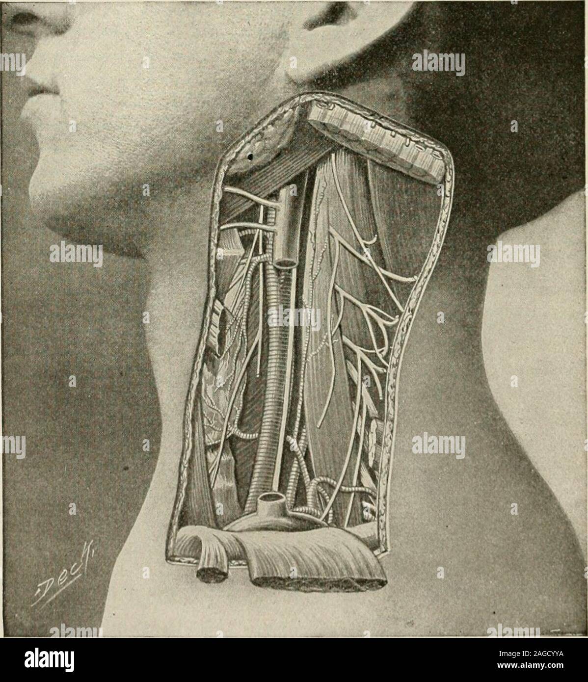 . L'anesthésie locale et régionale ; avec des chapitres sur la moelle, péridurale, et l'analgésie paravertébrale, parasacral, et d'autres applications de l'anesthésie locale et régionale pour la chirurgie de l'œil, des oreilles, du nez et de la gorge, et à la pratique dentaire. Fig. 2IO.-Hartel, montrant l'itinéraire de l'axe de l'aiguille de l'œil l'élève quand il est vu de face et à tubercule articulaire à la base du zygoma, lorsque vu du côté (photo d'cadavre.) (Hartel.). Fig. 211.-La région carotidienne et le chef des structures. Remarque La relation de le veine jugulaire, l'artère carotide commune, et le nerf pneumogastrique.(Campbell.) Banque D'Images