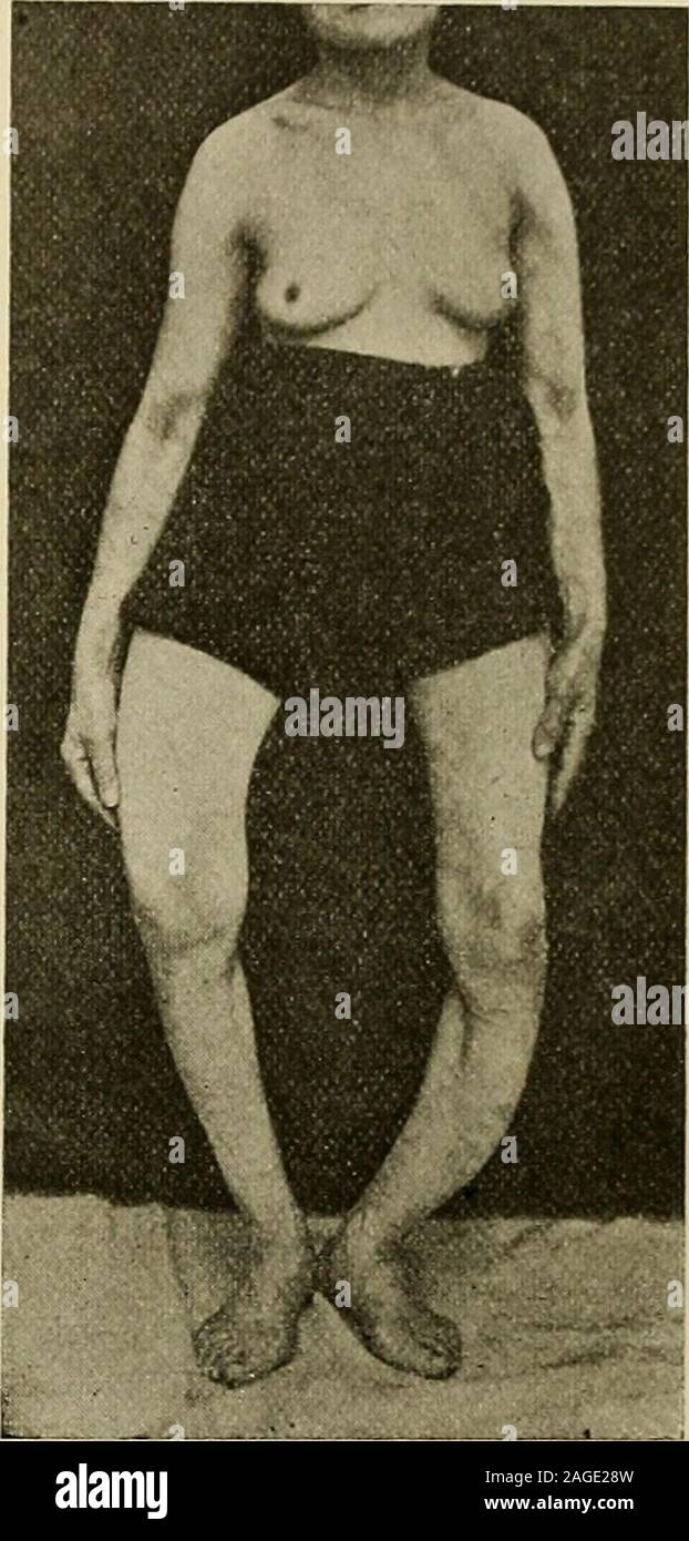 . La chirurgie moderne, général et du dispositif. Fig. 294.-Leontiasis ossium. Fig. 295.-Le Pagets maladies. une affaire impliquant l'os du crâne et du visage d'un côté. Le hypertrophyprogressively augmente, entraîne des difficultés de mastication, et s'accompagne d'byheadache. Elle produit une déformation distinctes de la mâchoire comme une tumeur, whereasacromegaly Agrandit toutes les proportions d'un os (Fig. 294). L'causeis inconnu. Il est lent en cours, qui semble maintenant cesser de faire avancer, d'nowadvancing avec plus de rapidité. Les changements osseux ressemblent à celles de l'osteitisdeformans. Les symptômes subjectifs sont dues à la pression. Banque D'Images