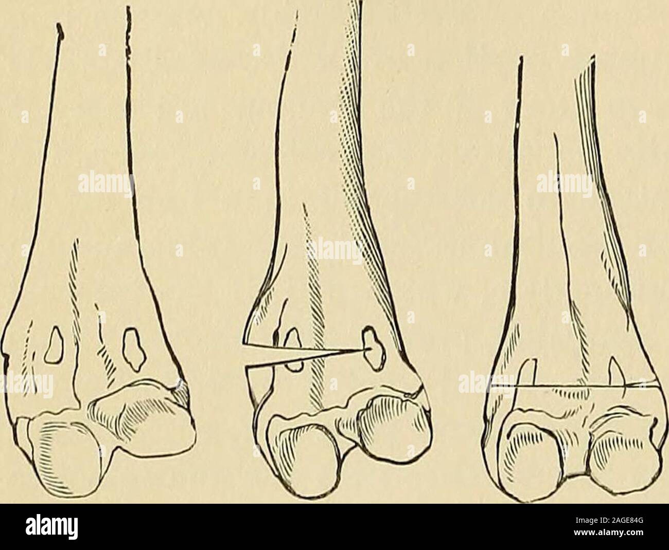 . Chirurgie du dispositif. Fig. 462.-Supracondy-ostéotomie loid, un incisionof.Direction des parties molles, h. Traitdu section osseuse épiphysaire, c.junction.d. L'épiphyse. 4M OPERATIVE CHIRURGIE. L'opération hy. Saiuing-Placer le patient dans la position dorsale ; flexthe sur la cuisse de la jambe complète. En un point de deux ou trois pouces au-dessus du condyle interne l'tipof introduire une tenotome sur la télévision, le mener vers le bas-ward, de l'avant, et vers l'extérieur jusqu'à son point peut être estimé en avant dans l'inter-. Banque D'Images