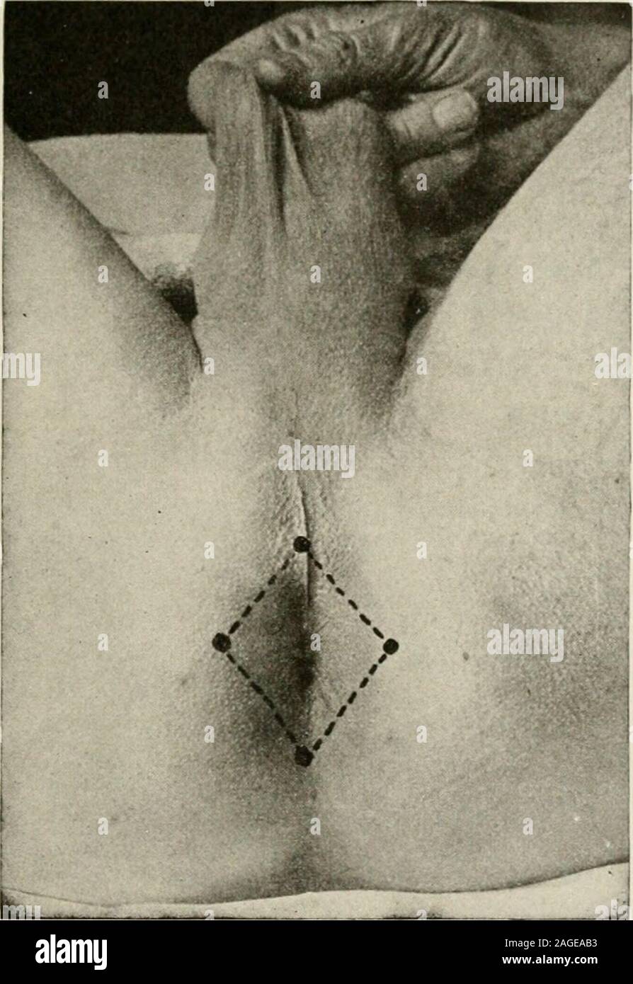 . L'anesthésie locale et régionale ; avec des chapitres sur la moelle, péridurale, et l'analgésie paravertébrale, parasacral, et d'autres applications de l'anesthésie locale et régionale pour la chirurgie de l'œil, des oreilles, du nez et de la gorge, et à la pratique dentaire. de l'ischion(Fig. 107), et si le champ opératoire s'étend à quelque distance behindand au côté du rectum, comme dans la fistule, l'inférieur sera également pudendal être bloqué sur le côté extérieur de l'ischion ; ces deux mesures sont discutées de proced au titre de la rubrique ci-dessus. Lorsqu'il est utilisé, ce methodshould combinée avec une infiltration périanale approfondie dans la même façon qu'un Banque D'Images