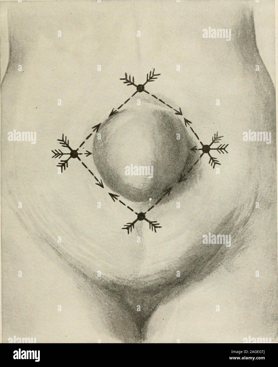 . L'anesthésie locale et régionale ; avec des chapitres sur la moelle, péridurale, et l'analgésie paravertébrale, parasacral, et d'autres applications de l'anesthésie locale et régionale pour la chirurgie de l'œil, des oreilles, du nez et de la gorge, et à la pratique dentaire. appareil d'infiltration ou grande seringue avec longneedle) et en passant l'aiguille dans tous les sens, un refus de la circonférence est faite dans tous les tissus sous-cutanés, créant ainsi une zoneof anesthésie. Si les muscles sous-jacents sont clairement définies, andthere n'existe aucun risque d'aller à travers eux, ceux-ci peuvent être infiltratedat le même temps ; sinon, cela n'avait être Banque D'Images