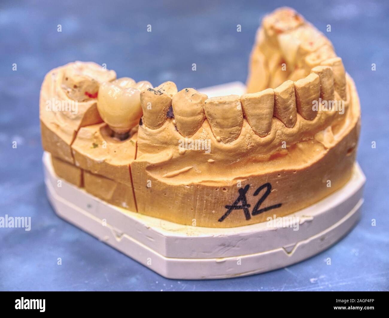 Les couronnes en céramique de zirconium et de la dent sur un modèle de gypse en laboratoire dentaire. Dentisterie orthopédie préparation pour la restauration de la couronne Banque D'Images