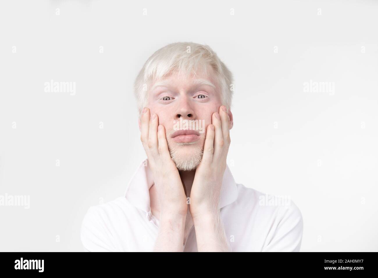Portrait d'un homme albinos dans studio habillé t-shirt isolé sur un fond blanc. déviations anormales. Aspect insolite anomalie de la peau. Banque D'Images