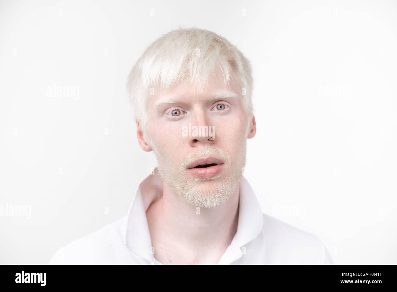 Portrait d'un homme albinos dans studio habillé t-shirt isolé sur un fond blanc. déviations anormales. Aspect insolite anomalie de la peau. Banque D'Images