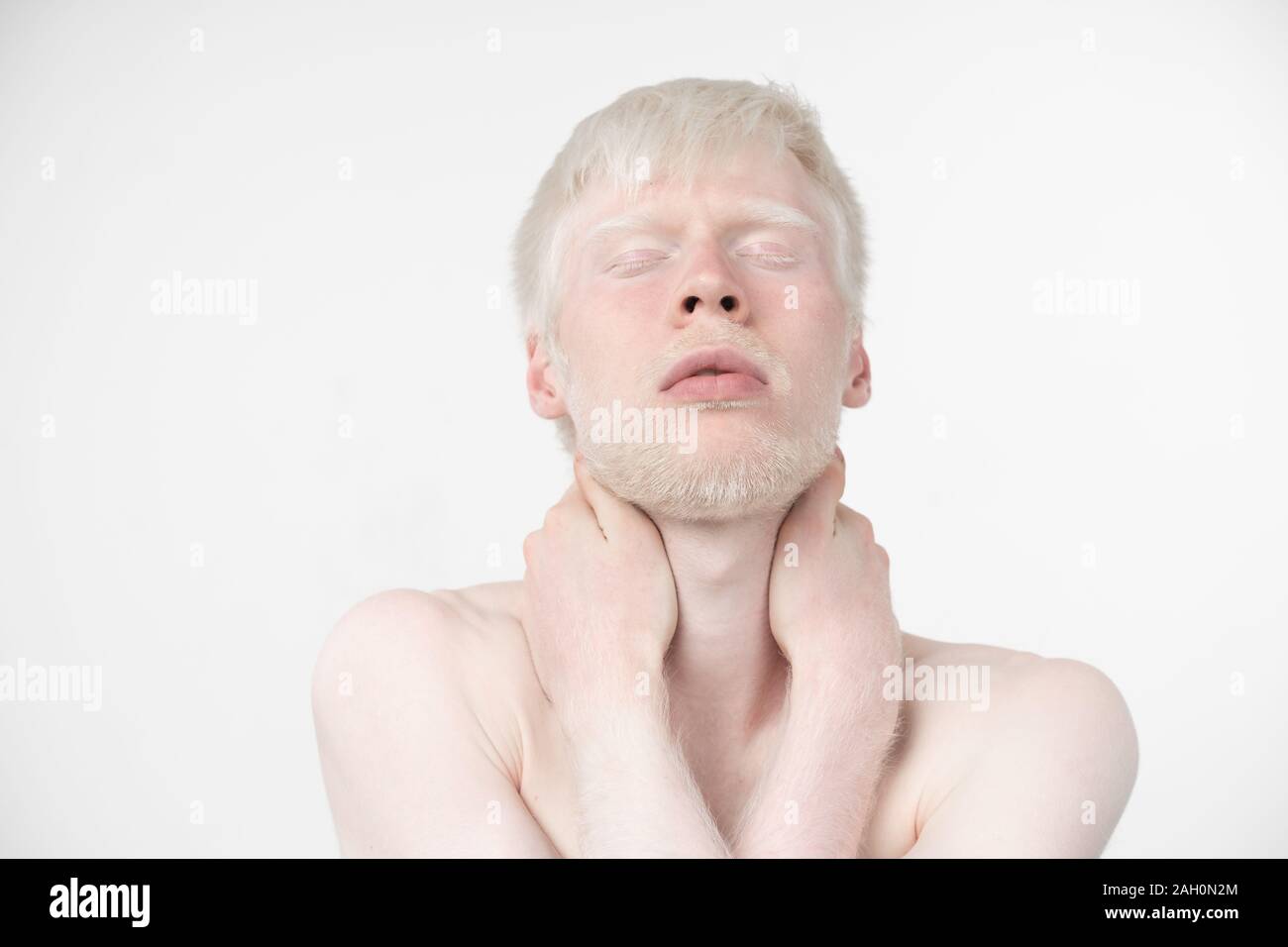 Portrait d'un homme albinos dans studio habillé t-shirt isolé sur un fond blanc. déviations anormales. Aspect insolite anomalie de la peau. Banque D'Images