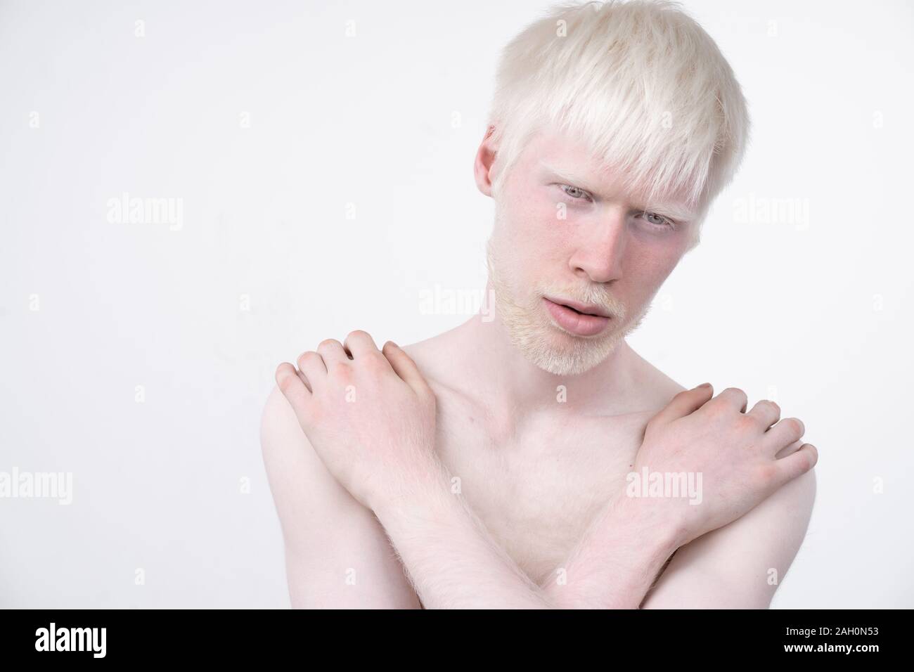 Portrait d'un homme albinos dans studio habillé t-shirt isolé sur un fond blanc. déviations anormales. Aspect insolite anomalie de la peau. Banque D'Images