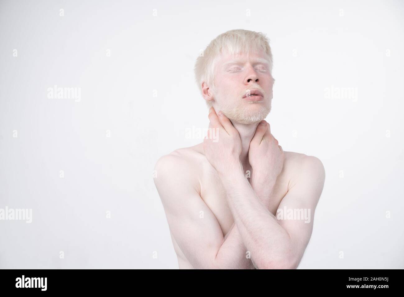 Portrait d'un homme albinos dans studio habillé t-shirt isolé sur un fond blanc. déviations anormales. Aspect insolite anomalie de la peau. Banque D'Images