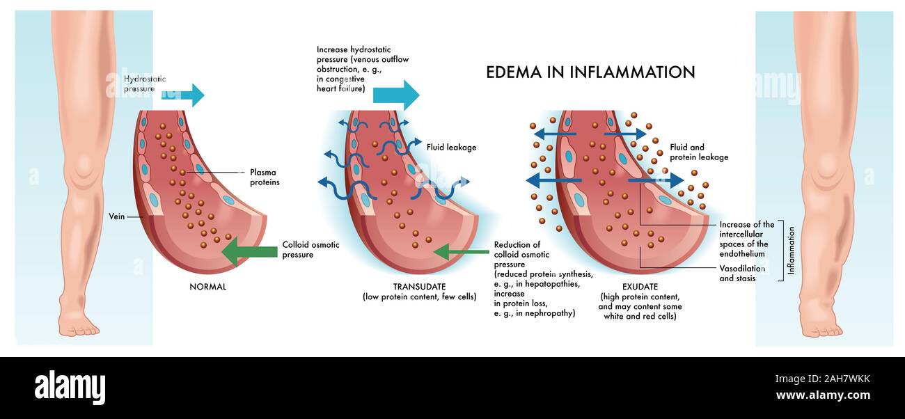 Principales étapes de l'oedème de l'inflammation l'illustre le schéma médical. Banque D'Images