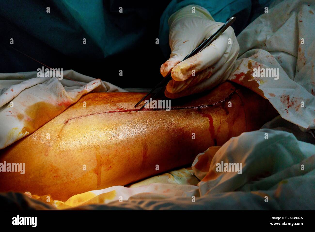 Patient sur incision chirurgicale en salle d'opération réelle de travail de l'équipe de chirurgiens Banque D'Images