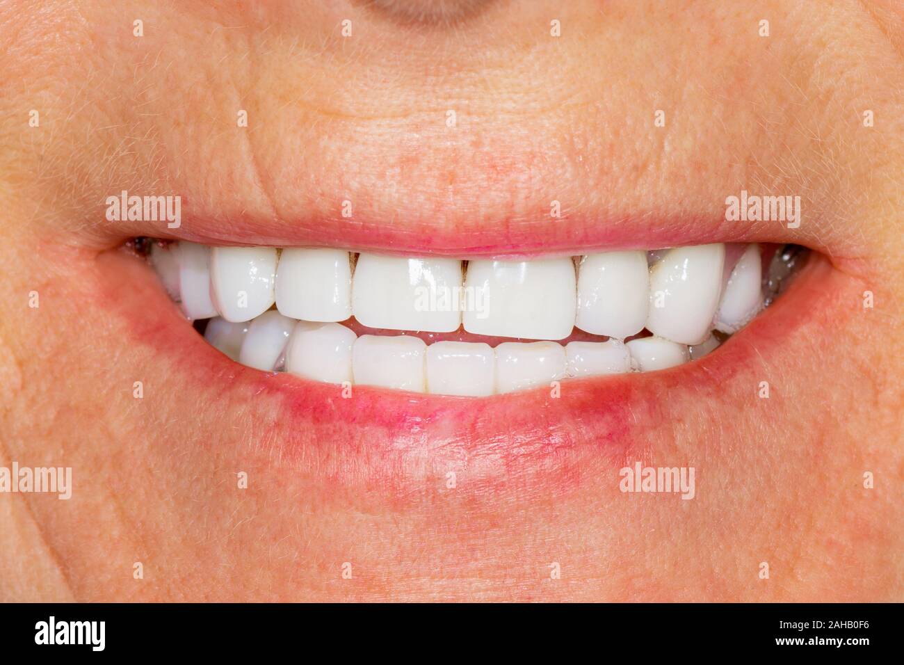 La restauration dentaire de la pourriture des racines de dents avec des couronnes en céramique. cast posts dentistry Banque D'Images