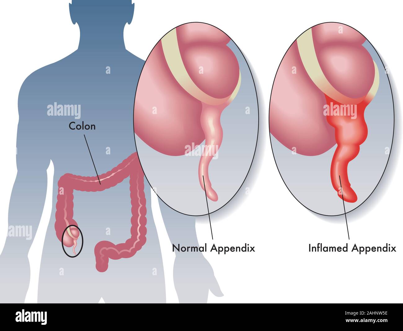 Illustration médicale de l'inflammation de l'appendice. Illustration de Vecteur