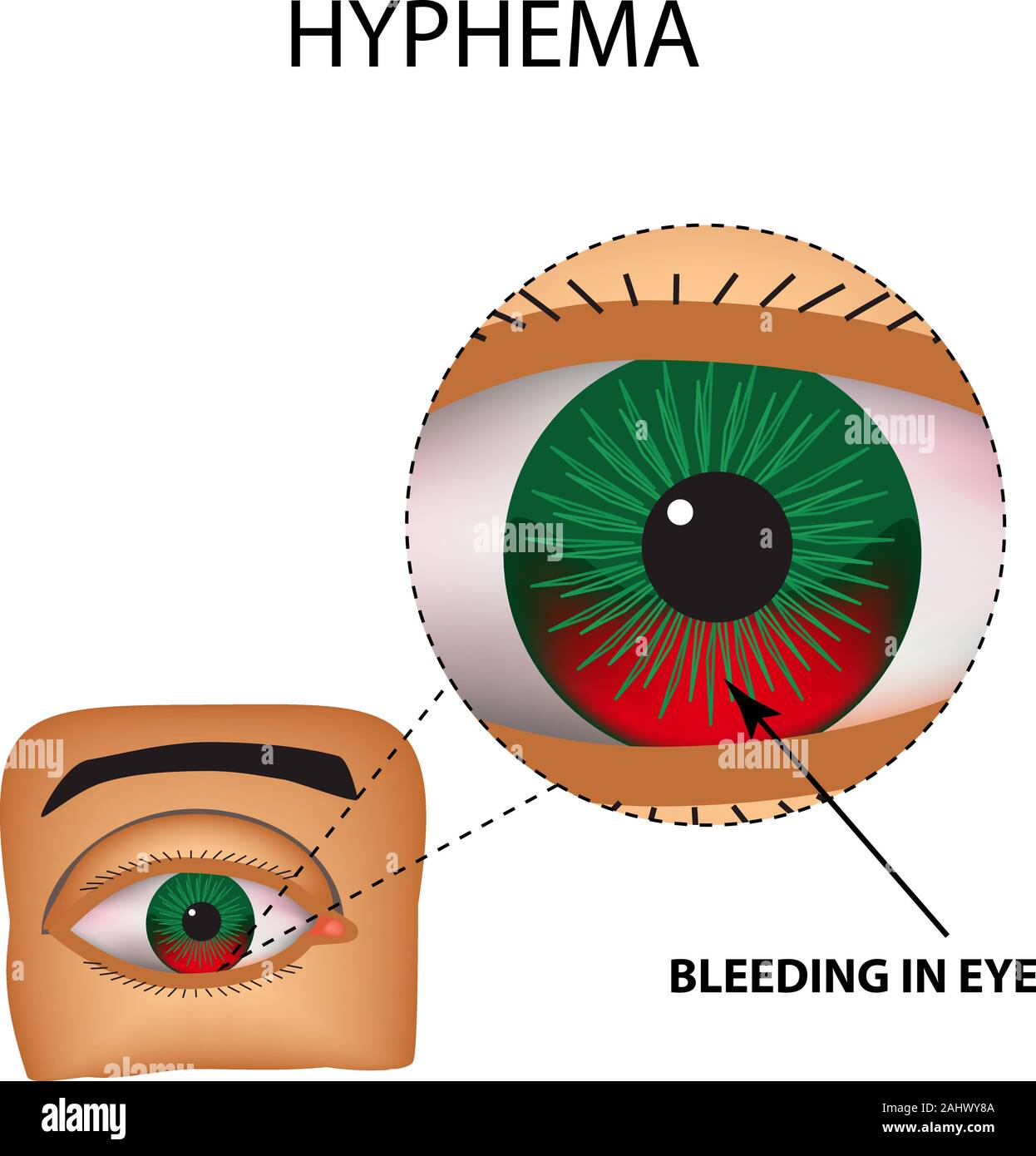 Eye hemorrhage cause Banque d'images vectorielles - Alamy