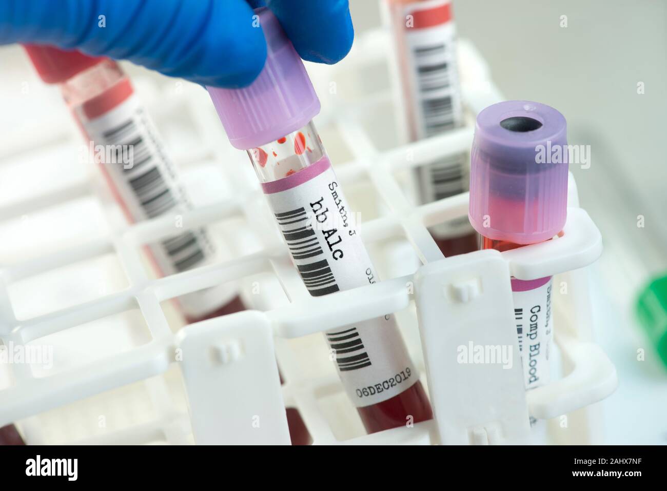 Hb A1c blood test tube rack de choisi par technicien de laboratoire. L'hémoglobine A1c test peut évaluer le contrôle du glucose et d'insuline dans l'efficacité du régiment de diam Banque D'Images