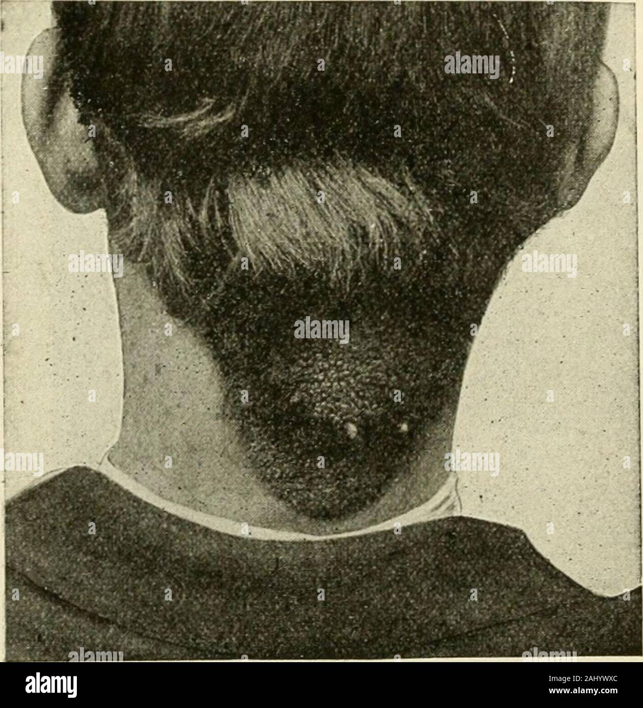 La chirurgie moderne, général et du dispositif . leche lobe du foie, le long de la vaisseaux rénaux et spermaticveins, dans le canal inguinal, et dans les grandes orientations des ligaments (American Text-Book pathologie). Les tumeurs épithéliales innocent.-Ces excroissances imiter un epithelialtissue de l'organisme sain et mature. Papillomata, ou des verrues génitales (Fig. 205).-Papillomata thetype sont formés sur des papilles cutanées et des muqueuses. Un papillomavirus se compose d'un fibrousstroma, qui contient des vaisseaux sanguins et lymphatiques et est couvert par l'epithe-lium de la variété relative à la partie malade. Papillomata dulimiteur de croître et de la peau Banque D'Images La chirurgie moderne, général et du dispositif . leche lobe du foie, le long de la vaisseaux rénaux et spermaticveins, dans le canal inguinal, et dans les grandes orientations des ligaments (American Text-Book pathologie). Les tumeurs épithéliales innocent.-Ces excroissances imiter un epithelialtissue de l'organisme sain et mature. Papillomata, ou des verrues génitales (Fig. 205).-Papillomata thetype sont formés sur des papilles cutanées et des muqueuses. Un papillomavirus se compose d'un fibrousstroma, qui contient des vaisseaux sanguins et lymphatiques et est couvert par l'epithe-lium de la variété relative à la partie malade. Papillomata dulimiteur de croître et de la peau Banque D'Images