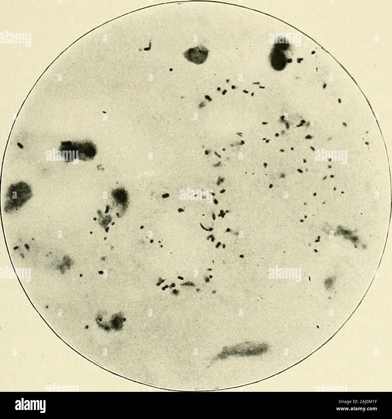 L'appendicite : sa pathologie et chirurgie . li. Thesepossess les mêmes caractères morphologiques que celles en theomentum, avec l'exception que les chaînes de cocci arelonger et plus nombreux. Les bactéries sont les plus abundantin la sous-muqueuse et dans l'exsudation péritonéale. Theaccompanying microphotograph est repris de l'ancien.Il donne une bonne idée des chiffres et caractères d'thebacteria (Fig. 51). C'est une question de savoir si certains d'themmay pas de capsules. ] Conférences sur Htinterian infecter traumatique inn. ]&Gt ;. 12, fig. 3. traitement ; femmes enceintes et 245 coopératives le bacille tuberculeux ont été searc Banque D'Images