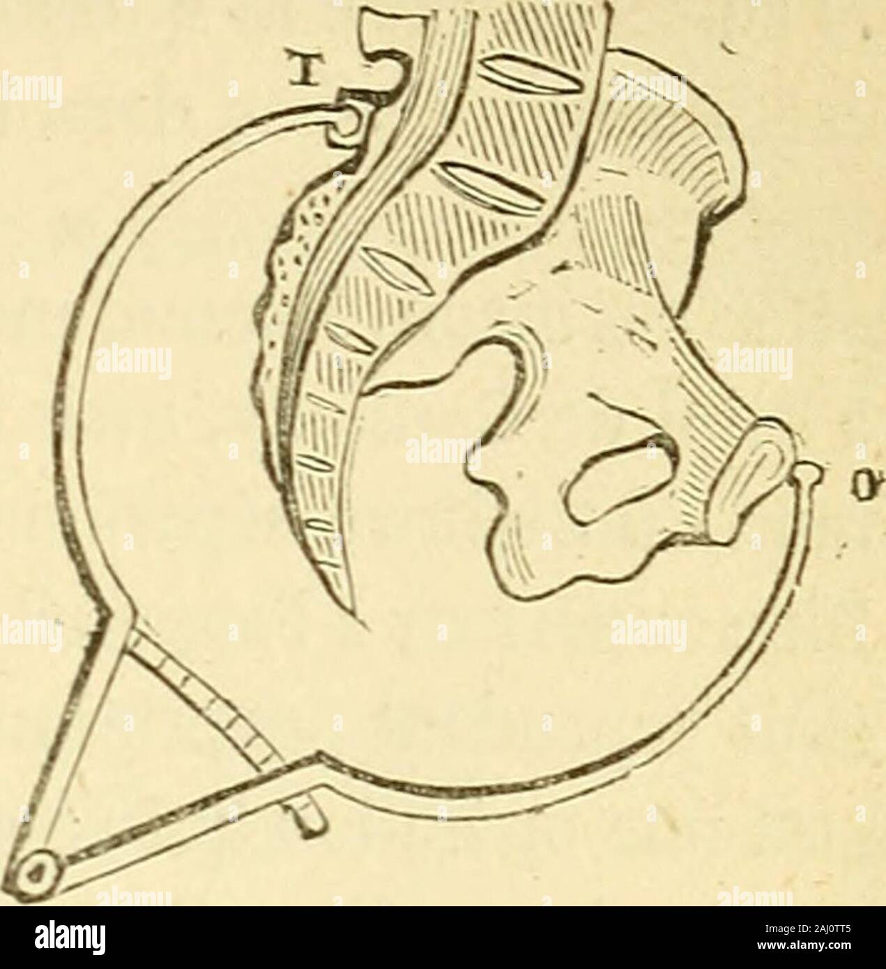 Arsenal de la chirurgie contemporaine : description, mode d'emploi, et appréciation des appareils et instruments internationaux en usage pour le diagnostic et le traitement des maladies chirurgicales, l'orthopédie, la prothése, les opérations simples, générales, spéciales et obstétricales . Fig.1758. - Pelvimèlrede Baudelocque. Fie 1759.- Mode demploi du pelvimètre de Baudeloopic. Les mars dépaisseur de Baudelocque ne permet de prendre que desmesures extérieures (fig. 1759) qui ne sauraient faire connaître exactementles divers diamètres du bassin. Pour arriver à ce résultat, il est indispen-sable dintroduir Banque D'Images