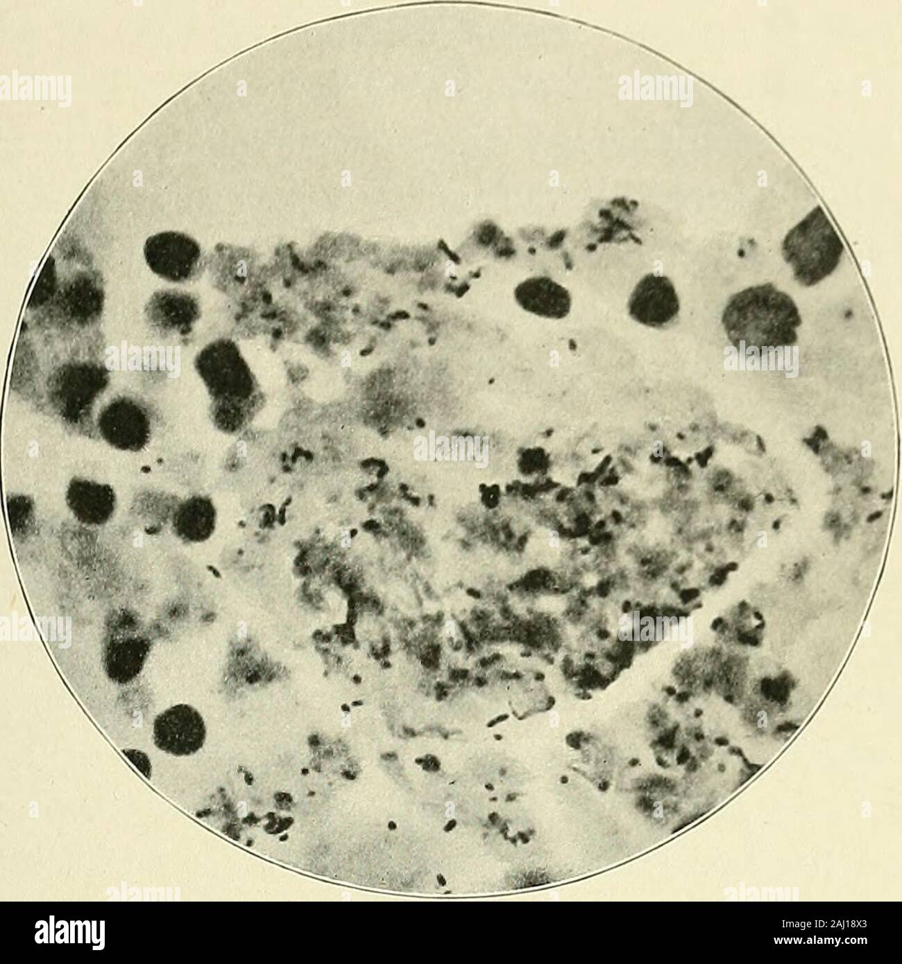 L'appendicite : sa pathologie et chirurgie . h granulés, puscells, cellules nucléées, cellules épithéliales, et de vastes quantités. ofbacteria Parmi ces derniers figurent les diplocoques cocci, bacilles, streptocoques, de tailles et de formes diverses, leptothrix, levures, andencapsuled diplobacilli ou diplocoques, car c'est difficile de dire la classe towhich ils appartiennent vraiment. Pas de bacille tuberculeux peut befound. Chaque fois que l'épithélium de l'appendice est détachée,un grand nombre de ces bactéries ont pénétré (Fig. 11) ; et, bien que l'microphotograph ne le montre,il est bien évident que la plupart d'entre eux ont saisi Banque D'Images