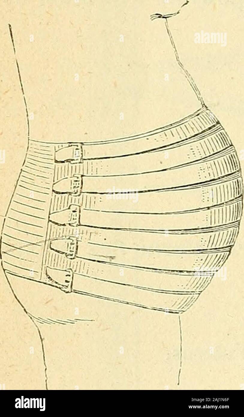 Arsenal de la chirurgie contemporaine : description, mode d'emploi, et appréciation des appareils et instruments internationaux en usage pour le diagnostic et le traitement des maladies chirurgicales, l'orthopédie, la prothése, les opérations simples, générales, spéciales et obstétricales . 84, et Bulletin de thér., 1857, t. LU, p. 489).- Bricheteau, sw-fuli-é p i de la compre ion ( h . génér. de méd., t. XXVIII, p. 92). 924 instruments. ivraie élastiques de Bourgeaud, quand il existe dans labdomen des inéga-lités ou une tumeur, un inspiré à Gourty (1) lidée dune ingénieuse modi-fication (fig. 1645) : " Elle (la c Banque D'Images