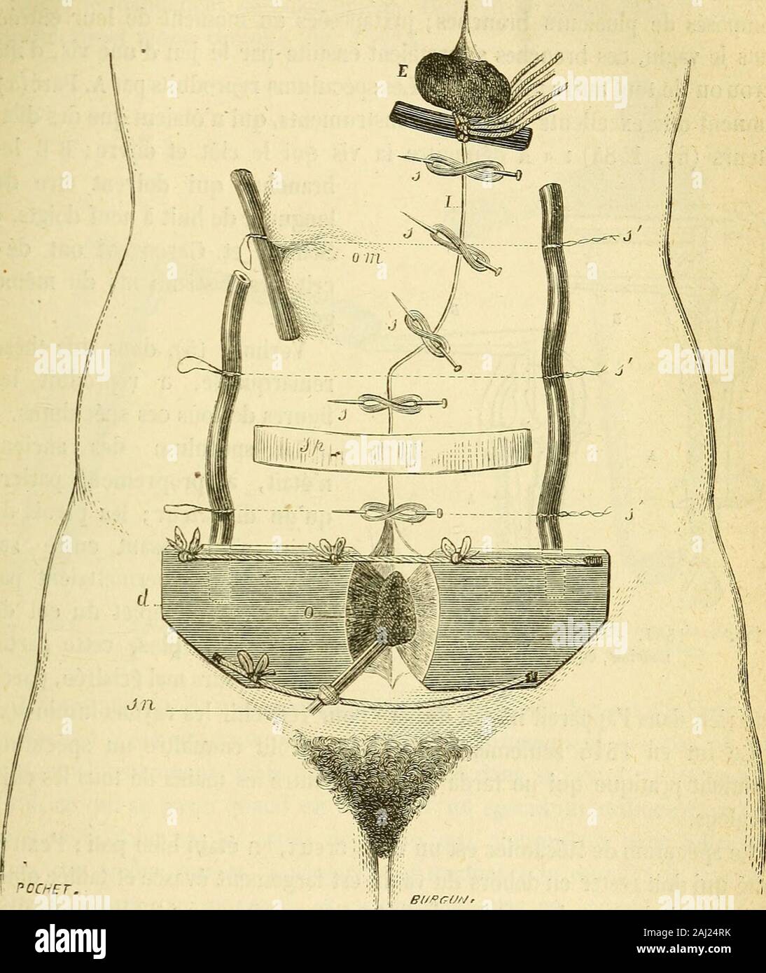 Arsenal de la chirurgie contemporaine : description, mode d'emploi, et appréciation des appareils et instruments internationaux en usage pour le diagnostic et le traitement des maladies chirurgicales, l'orthopédie, la prothése, les opérations simples, générales, spéciales et obstétricales . ieure de la plaie est un dépiploon E partie momifié. Si Koeberlé redoute une hémorrhagie ou une exsudation abondante, ilplace à demeure, dans langle inférieur de la plaie, des tubes en verre dontlextrémité-plonge jusquau fond du petit bassin. Lextraction des liquidesse fait au moyen dune poire de caoutchouc adaptée à lex Banque D'Images