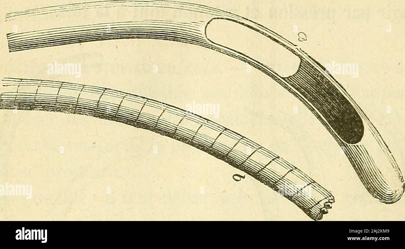 Arsenal de la chirurgie contemporaine : description, mode d'emploi, et appréciation des appareils et instruments internationaux en usage pour le diagnostic et le traitement des maladies chirurgicales, l'orthopédie, la prothése, les opérations simples, générales, spéciales et obstétricales . Fie 1493. - Sonde-magasin dHeurteloup modifieepar dÉtiolles, Leroy. Fig. 1494. -Sonde-magasinde Pasquier. Pasquier traffic increased considérablement les yeux de la sonde dHeurté-loup (fig. 1^94 et 1Zi95), et a supprimé le pas de vis qui sépare le bec dela sonde de son corps ; la grande ouverture des yeux permet de nettoyerlinst Banque D'Images