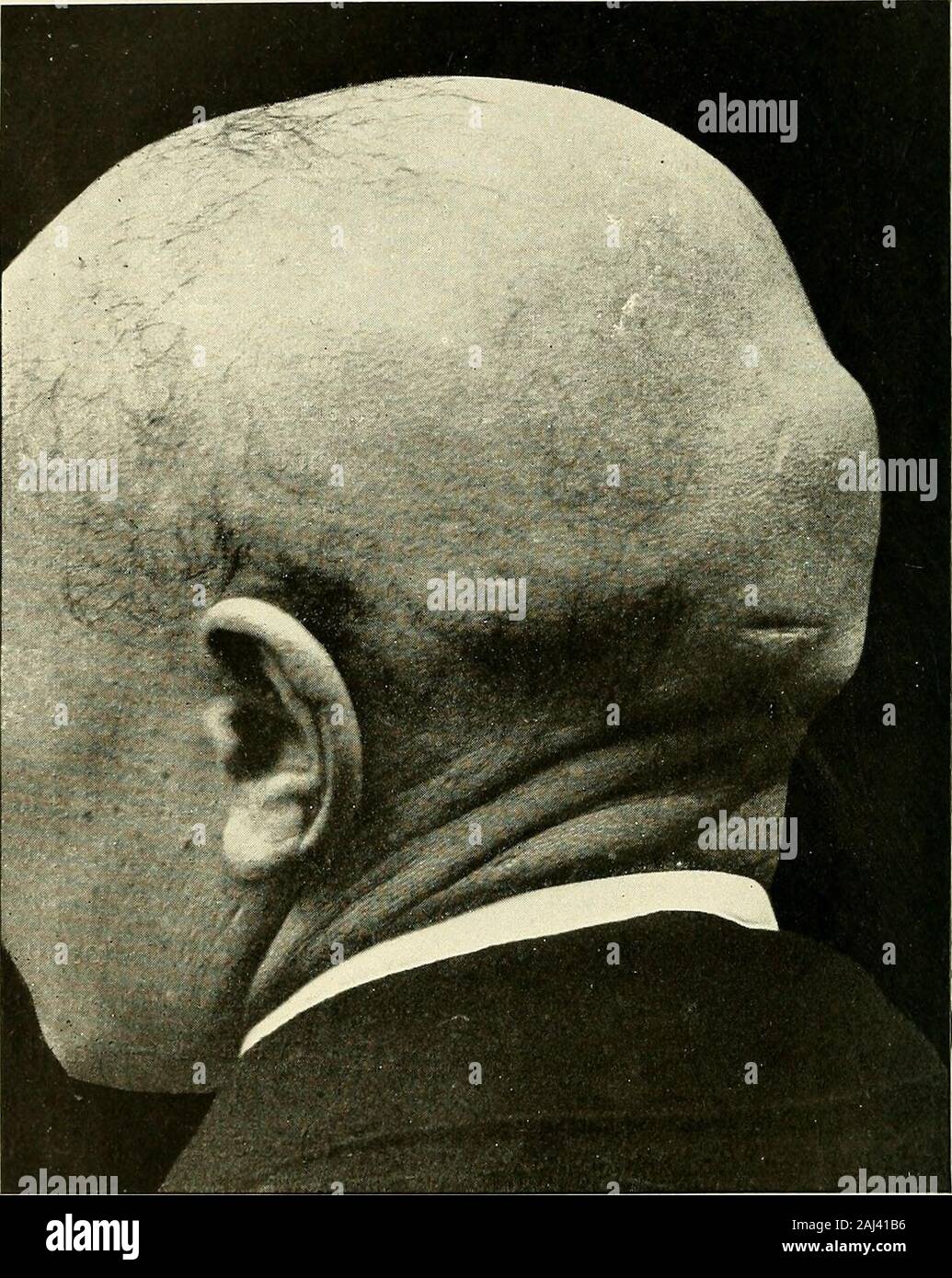 Recherche et diagnostic de l'hérédo-syphilis tardive . FlG. 11. Crâne natiforme. syphilitiques et qui, conséquemment, un stigmatepathognomonique diiérédo semble constituer-syphilis. III. Enfin, une malformation beaucoup plus rare consiste dansun renflement qui se produit à la partie postérieure du crâne, sur larégion occipitale, et qui forme là une bosse occipitale plus ou moinsvolumineuse, plus ou moins proéminente, et facile à constater quandelle est aussi nettement accusée que sur la figure 12. 4N STIGMATES CRANIENS. B. - DES MALFORMATIONS GÉNÉRALES. ?- Il est CLirieux riiéré iion moiiis devoir Banque D'Images