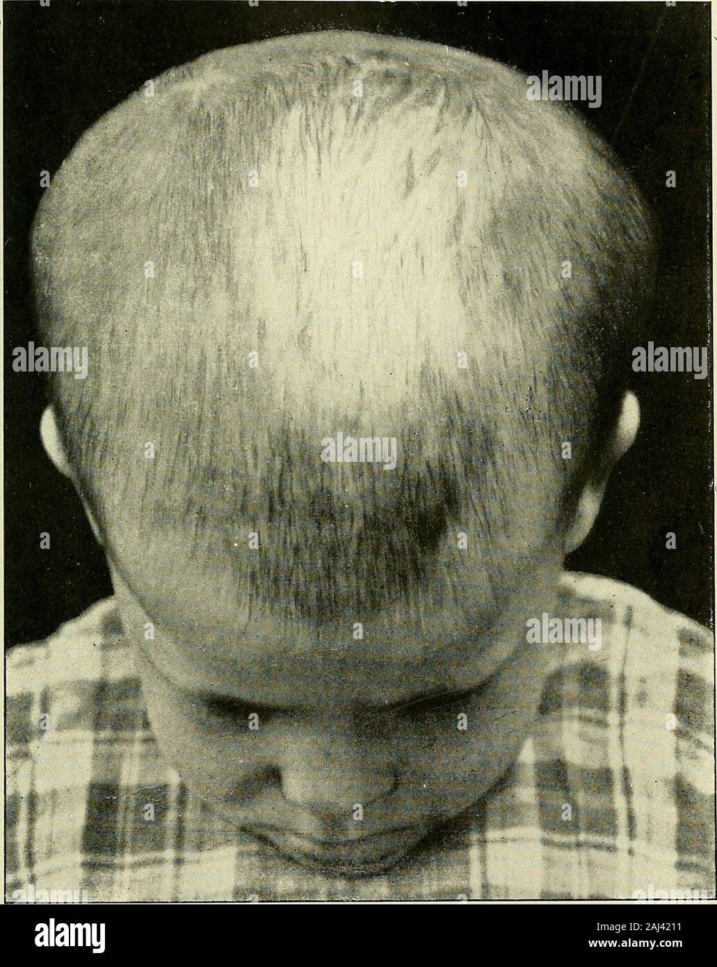 Recherche et diagnostic de l'hérédo-syphilis tardive . FiG. 8. - Carène ...