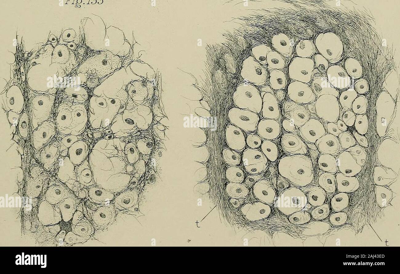 L'origine de la maladie : en particulier des maladies causées par l'opposition comme intrinsèque à des causes extrinsèques : avec des chapitres sur le diagnostic, le pronostic et le traitement . yioo rmn.Yl A i ! Fig. 132 Fig. 133. La moelle épinière. 161 est une connexion me fait croire qu'il y doit y avoir un underlyingcause qui induit tous les deux. Fig. Ofdisease 130 présente un état qui n'aurait pas été de très longue date, pour le de-struction de fibres nerveuses est si complète et s'étend sur plus de si grande aide denettoyant qu'une grande partie du cordon doit avoir été ren-comme inutile. Il n'y a presque pas de fibres nerveuses Banque D'Images