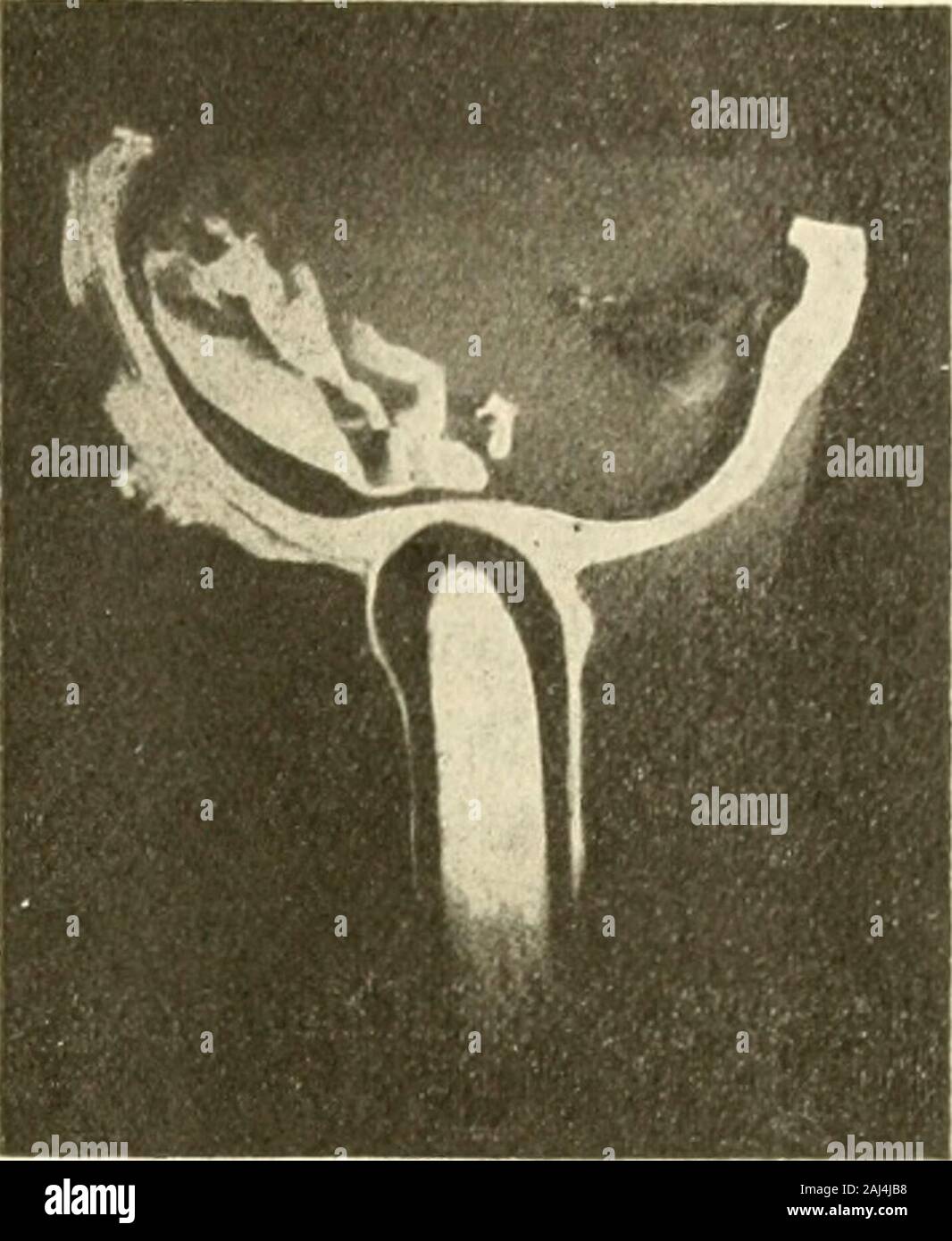 Die Neurologie des auges Ein Handbuch für Nerven- und Augenärzte . Fig. 142. Fig. 143. E. H. dans Blutung Sehnervenscheide Schädelbasisfraktur die Rechte bei.Photographiert Le Dr von Reuter. Dans der Beobachtung von Scheidenhämatom Bergmanns mit (484)waren auf der linken Seite der die base koaguliertem Bluteerfüllt mit Gruben, auch sonst reichliche Blutansammlung zwischen Knochen und oder,Dura der rechten Hemisphäre vorhanden. Am 4. Guerre linksStauungshyperämie Tage zu konstatieren. Tod am 6. Tage. En unserem Falle C. H. mit Scheidenhämatom subdurales Häma, grosses-tom dans der rechten Stim- und Banque D'Images