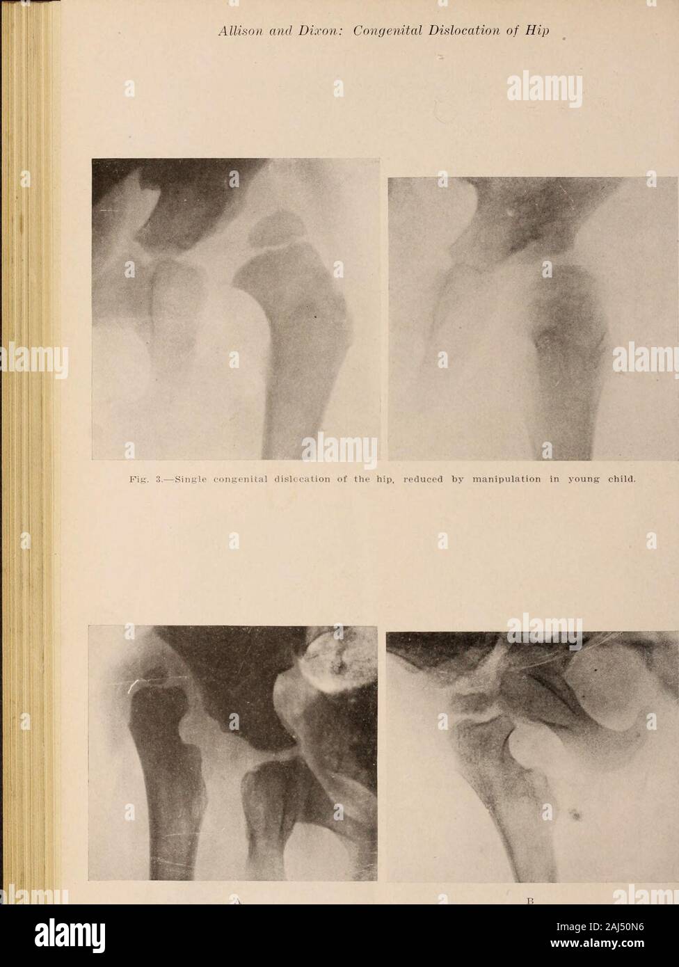 Interstate medical journal . Fig. 2.-une luxation congénitale de la hanche.. Fig. 4.-une luxation congénitale de la hanche en enfant de 4 ans. A, avant l'opération ; B, après l'opération. Allison et Dixon : Luxation congénitale de la hanche Banque D'Images