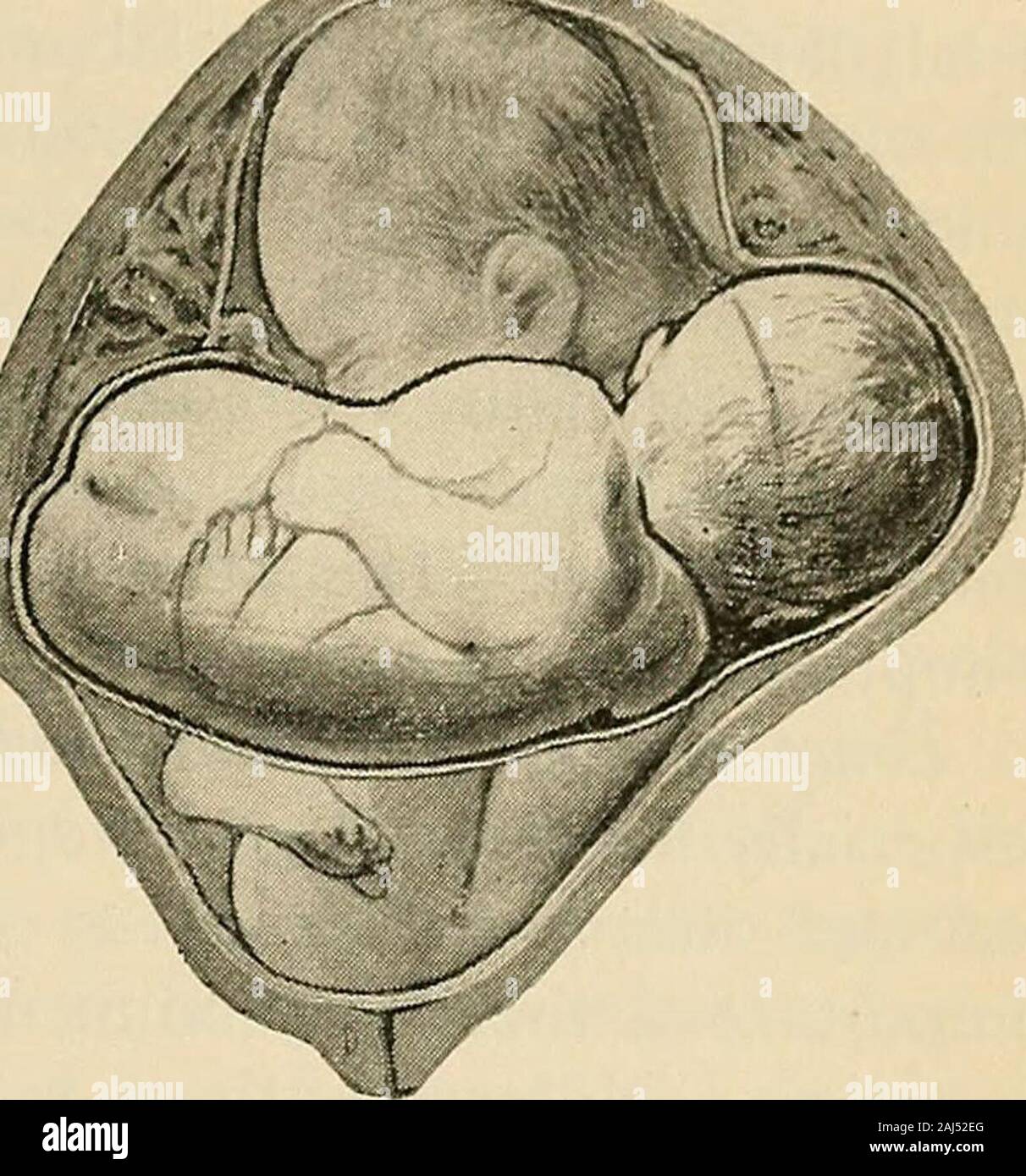 Un manuel d'obstétrique . Fio. 136.-jumeaux, il.Td et présentation du siège (Dickinson). Pluriel de naissances vivantes. 487. Fig. 137.-jumeaux, culasse et transversal présenta-tion (Dickinson). Deux fœtus en position normale, le deuxième fœtus ayant toaccommodate sa position à l'espace alloué. Quand bothheads usuallylie présents, ils dans le diam oblique situés à partir de du bassin, avec l'occiput antérieur (L. O.A. et R, O. A.), moreroom étant ainsi offerte.Le 07der de livraison. alsovaries Ainsi, lorsqu'bothheads usuallythe aujourd'hui, il est plus grand que est deliveredfirst ; si l'un présente par thebreech et l'autre par Banque D'Images