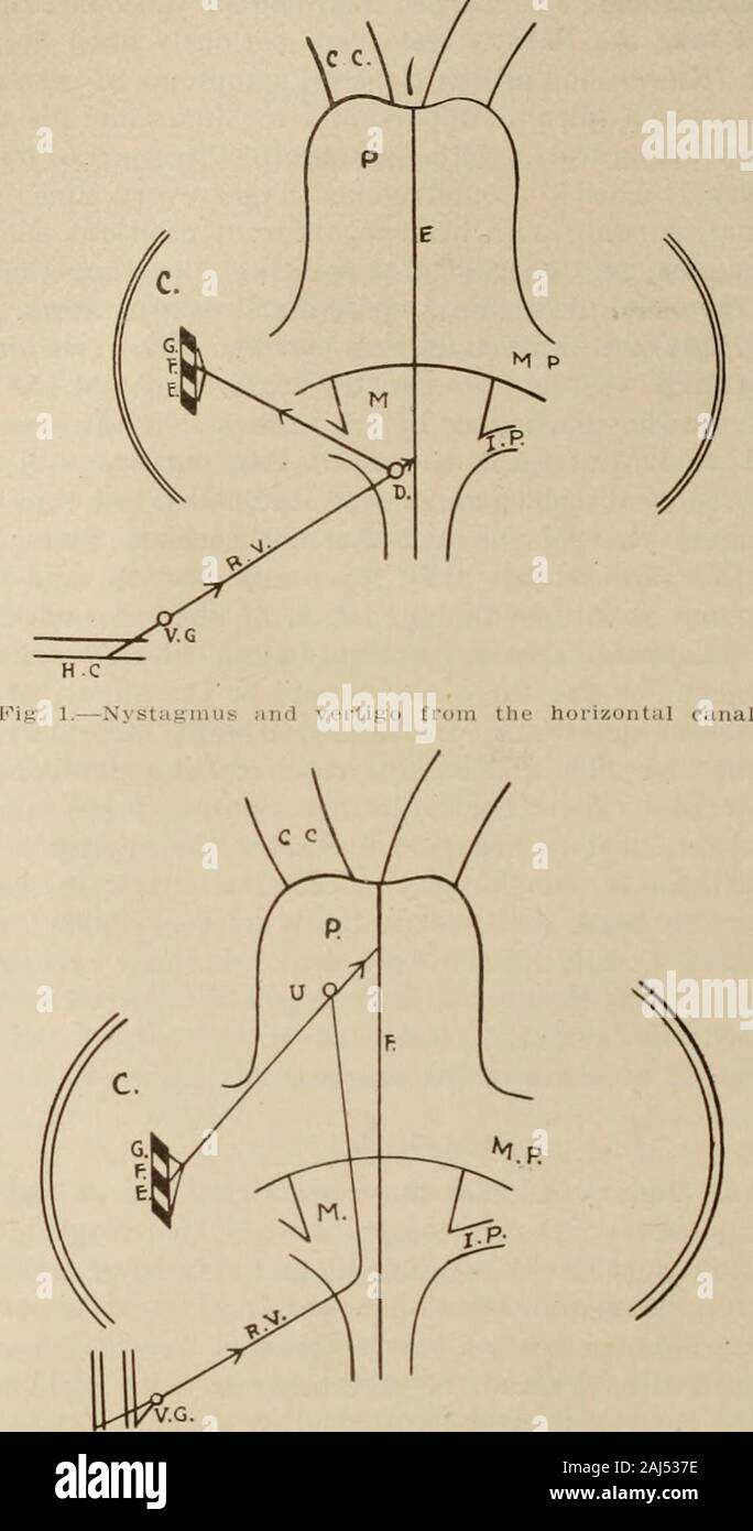 Interstate medical journal . t doit être entendu que ceux qui pratiquent sont notneurologists neurotology, pas plus qu'ils ne tentent de faire des diagnostics neurologiques.Ils estiment que, tout comme l'ophtalmologiste peut être de service à theneurologist dans l'examen des yeux et des nerfs optiques withtheir voies intracrânienne, de sorte que le otologist assistanceby peut-être d'examiner les oreilles et les nerfs huitième avec leur pathwaysthrough neuraxis, le cervelet, et le cerveau. Tous les cas ofvertigo, quelle que soit la cause première, est finalement le résultat d'une perturbation de l'appareil vestibulaire (statique labyri Banque D'Images