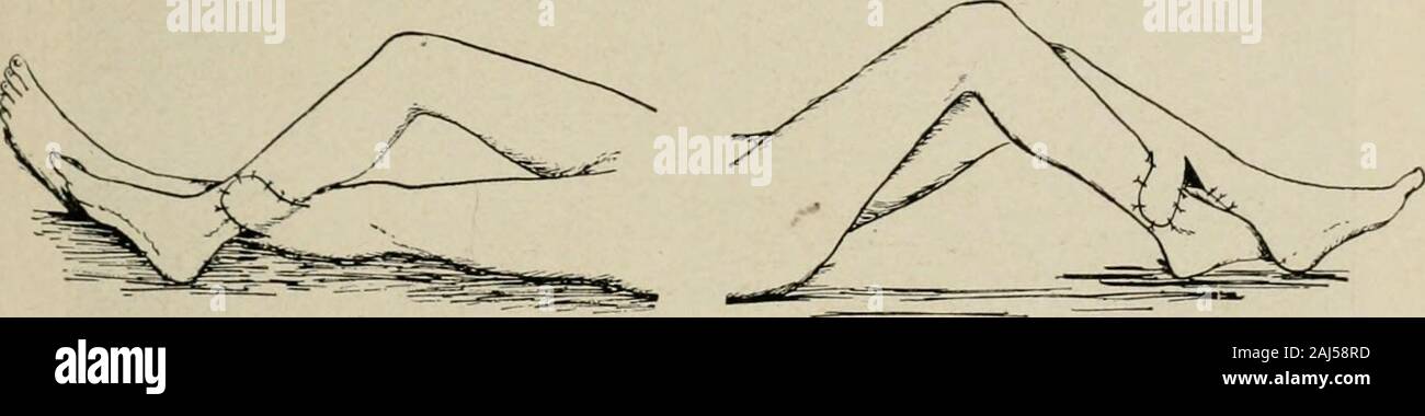 La chirurgie plastique ; ses principes et pratiques . Fig. 827. Fig. 828. Fig. 827 et 828.-Position prise dans l'obtention des mêmes volets pour coverdefects la cuisse sur la jambe.-c'est une position très ennuyeuse et ne doit être utilisé en exceptionalcases.. Fig. 829. Fig. 830. Fig. 829 et 830.-Position prise dans l'obtention de la jambe opposée des volets pour couvrir les défauts sur les surfaces internes et externes du tiers inférieur de la jambe. Banque D'Images