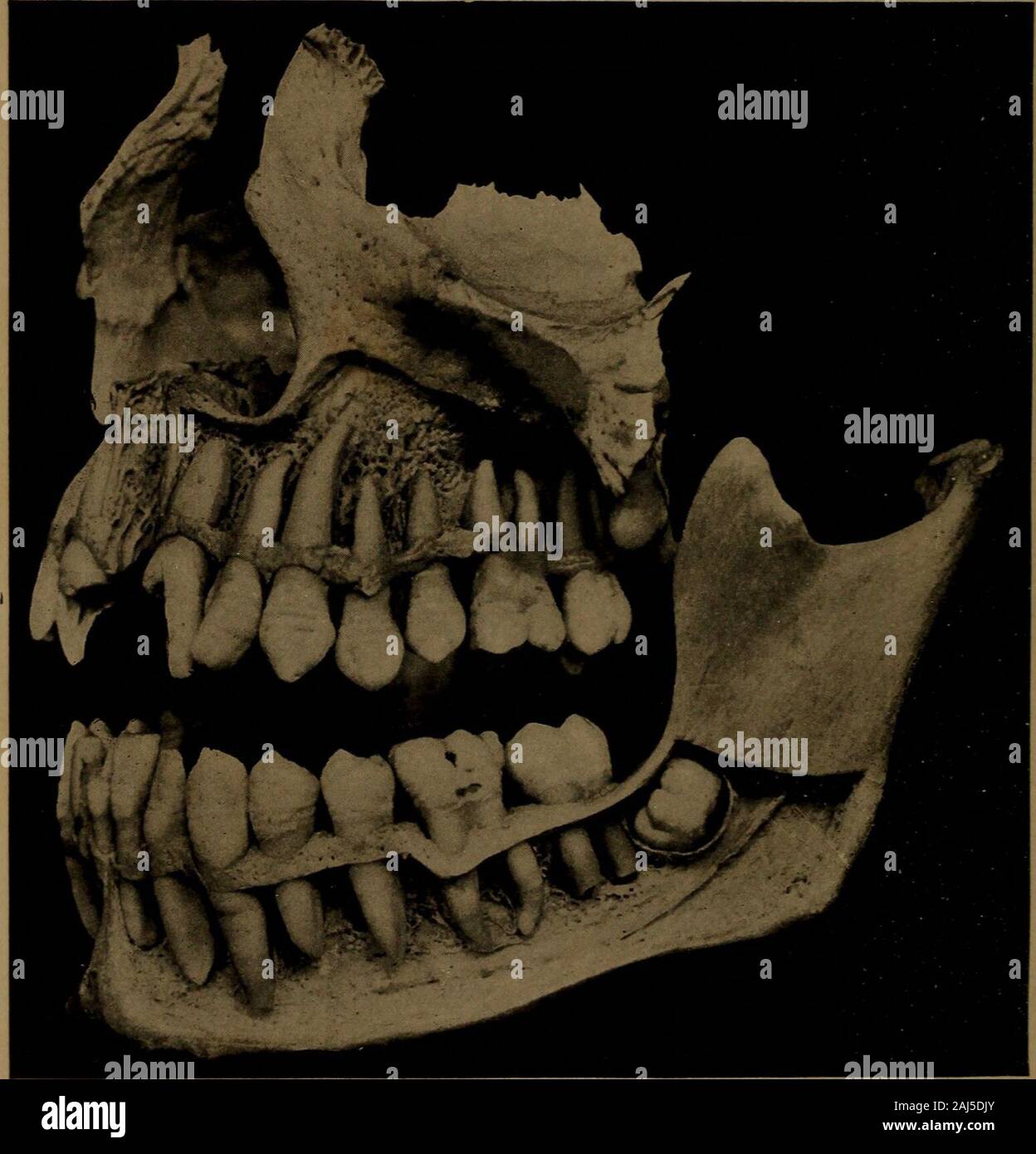 Un texte-livre d'Histologie et Embryologie dentaire, y compris les directions de laboratoire . La dentition la treizième année. Remarque Le rapport de la couronne à theroots bicuspidie de la basse molaire temporaire. Une déviation de la relation normale de ces dents willentirely changer la direction des forces, et sera mani-fested par une modification dans le développement de l'os.dans le crâne à cette période, les prémolaires sont vu couché molaires temporaires, et accueilli la deuxième molaire développe à26 402 LES DENTS ET LE DÉVELOPPEMENT DE LA FACE l'extrémité distale de la première. Leur croissance est transmise par le t Banque D'Images