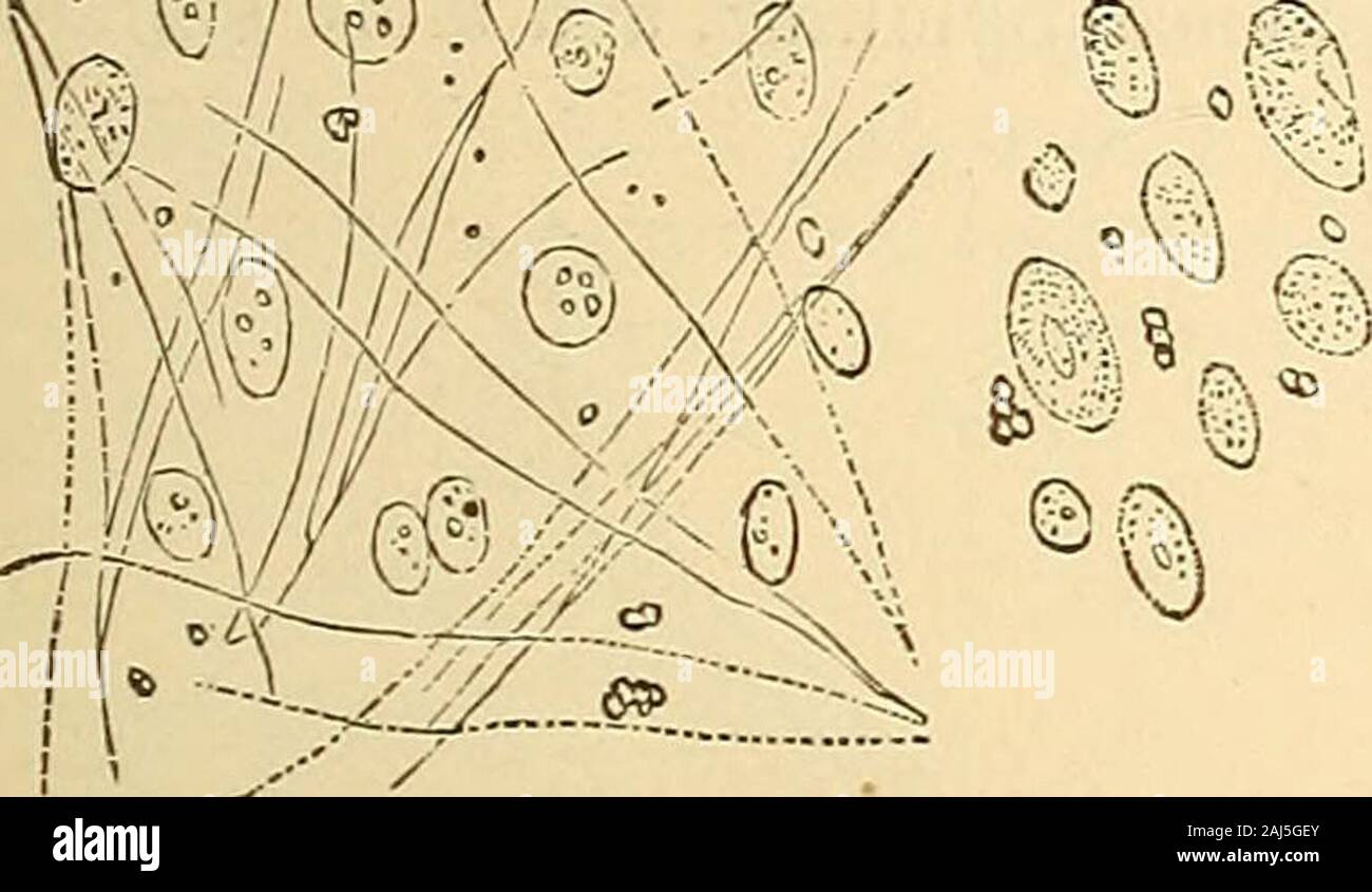 Conférences cliniques sur les principes et la pratique de la médecine . ^MAa. Fig. 203. Fig. 201. À une occasion, la question de gelati-nous dans le rein containednumerous thanonce granules ; et plus j'ai trouvé dans le centre de l'ambre clair une substance creamywhite masses,soit en totalité, gran-ular (Fig. 322), ou dans la formation de globules de pus en processof. 4. Le kyste peut être distendedwith haveevidently les cellules épithéliales qui été éjectés de l'itsinternal surfice, et été com-Heuce, sur examen, "& Banque D'Images