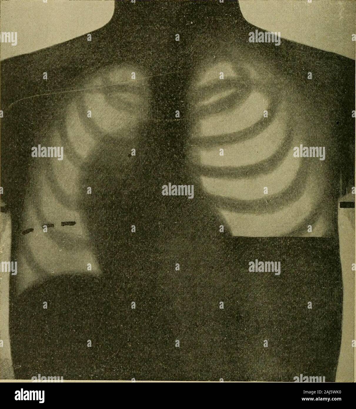 Les rapports médicaux et chirurgicaux . n défaut rapidement depuis le matin ; respira-tion a été plus rapidement. Échec d'impulsions et il est mort à 15 h 10 Le déplacement du cœur et du poumon a été beaucoup plus grand dans ce que le patient est trouvé dans les patients avec une ouverture permanente dans le ch( !Ht, comme après une opération de l'empyème, qui llui air dans les 194 OBSERVATIONS SUR PNEUMOHYDEOTHORAX. côté droit du thorax était probablement sous plus de l'atmos-pheric, pression et été pompée dans le sac pleural par avalve-comme l'ouverture. Cas IV. -Delia H., vingt-cinq ans, est entré dans mon service à l'hôpital, le 3 avril Banque D'Images