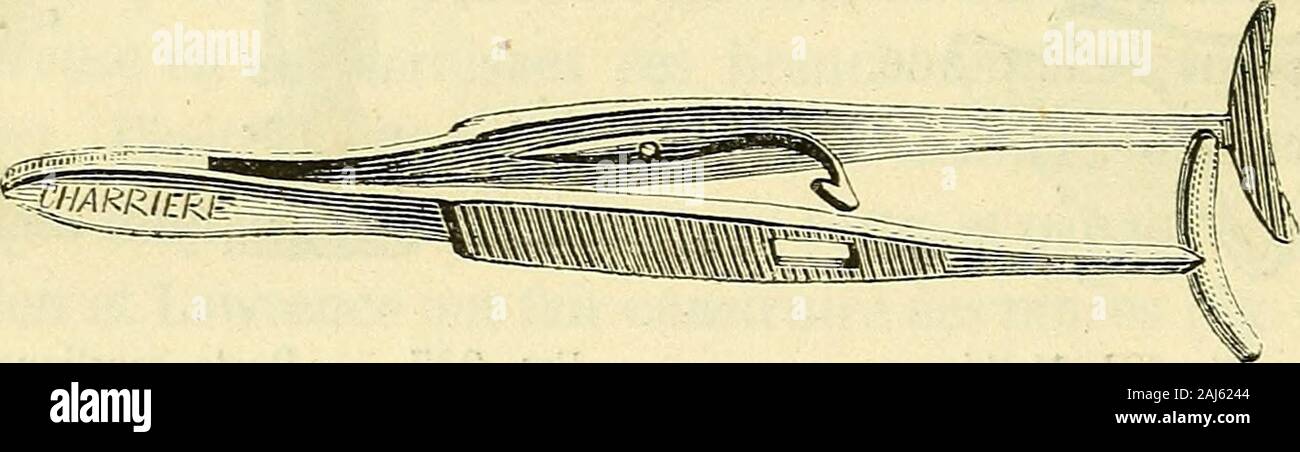 Arsenal de la chirurgie contemporaine : description, mode d'emploi, et appréciation des appareils et instruments internationaux en usage pour le diagnostic et le traitement des maladies chirurgicales, l'orthopédie, la prothése, les opérations simples, générales, spéciales et obstétricales . Fig. 928. - Pince élastique de Siebel. À défaut de la pince de Sichel, on peut placer deux fils, darchal lunau-dessus, lautre au-dessous du repli palpébral et en tordre lesextrémités attenante. La quantité de peau à enlever étant bien précisée, lopérateur saisit le pliavec des pinces solides en arrière desquelles il fait le Banque D'Images