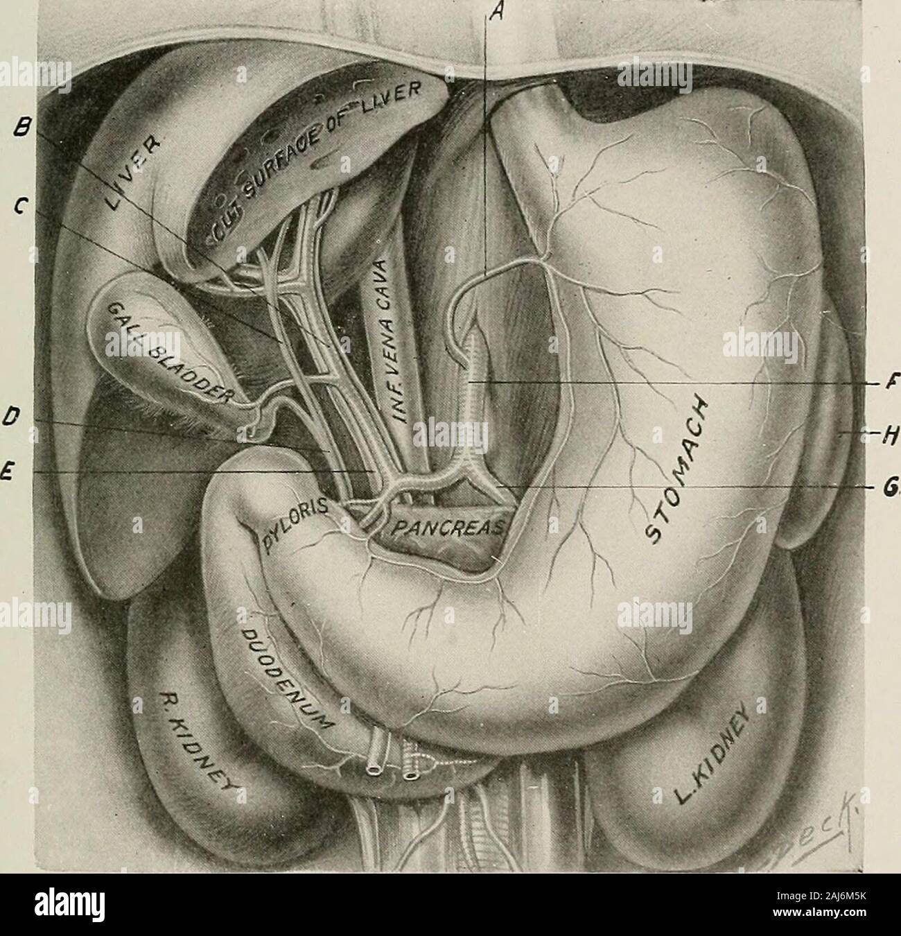 Traitement chirurgical ; un traité sur les pratiques de traitement des maladies chirurgicales pour l'usage des praticiens et des étudiants de la chirurgie . Fig. 1375).   L'estomac est recouverte de péritoine partout sauf à l'intérieur des frontières d'thegreater et moindre au courbures et zones triangulaires à chaque extrémité. Il est attaché au diaphragme par l'œsophage, et à la paroi abdominale postérieure par le duodénum.le fundus est attaché au diaphragme par le ligament gastrophrenic spleenby, et à l'épiploon gastro-splénique La ; la petite courbure est relié au foie par l'épiploon gastro-hépatique ; la Banque D'Images