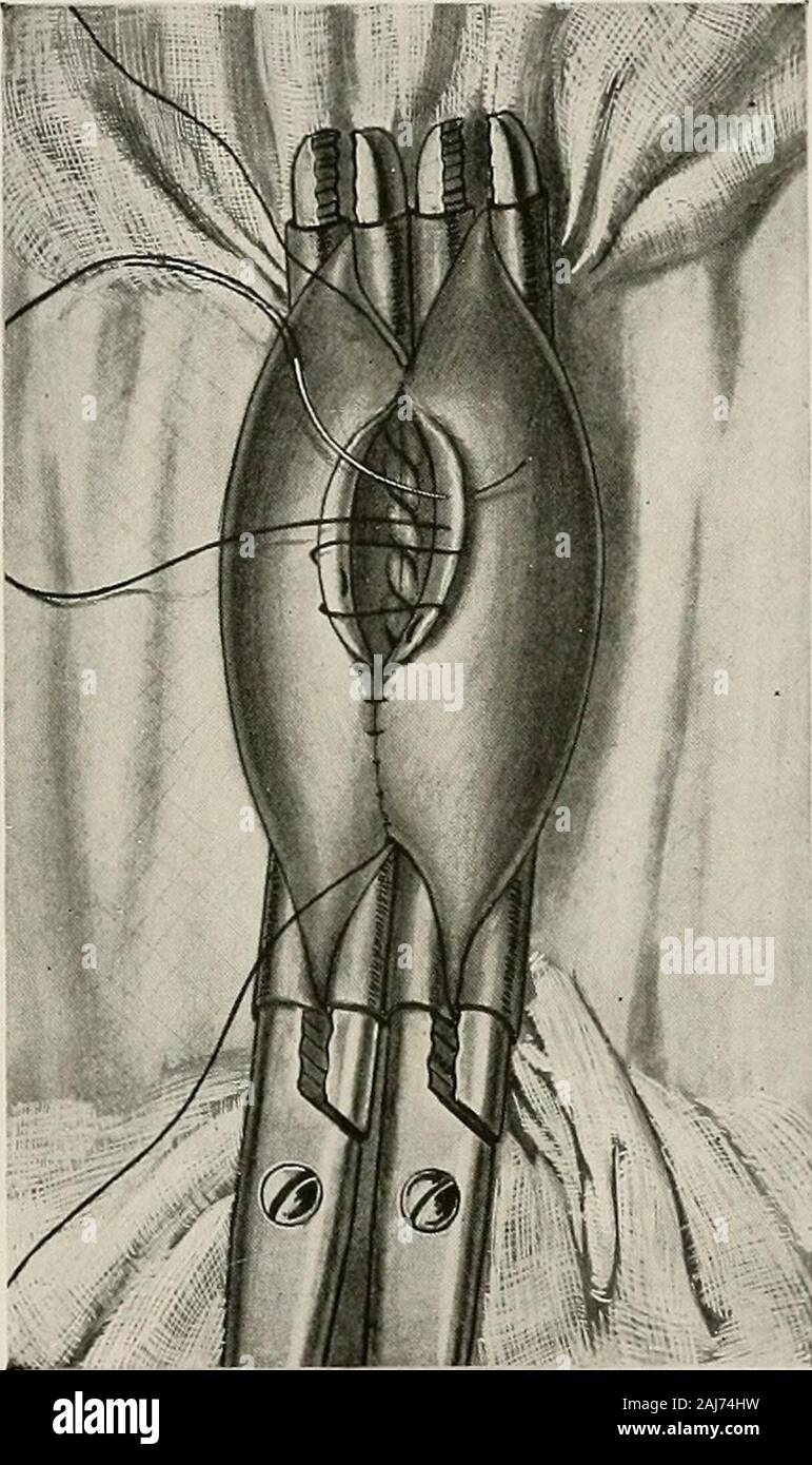 Traitement chirurgical ; un traité sur les pratiques de traitement des maladies chirurgicales pour l'usage des praticiens et des étudiants de chirurgie . appliedwith ce degré de couple que de fermer la lumière de l'intestin. À ce stade, les pinces peuvent être retirées. Le reste de l'outerstitch est maintenant terminé. L'un des aiguilles qui avaient été mis de côté est l'ABDOMEN 665 pris en main et la suture a continué autour de la fin de l'suturé openingat la même distance qu'avant (Fig. 1334). Cela se termine après l'arrondissement thecorner, et l'autre aiguille est ensuite utilisé pour terminer la circonférence de la CUS Banque D'Images