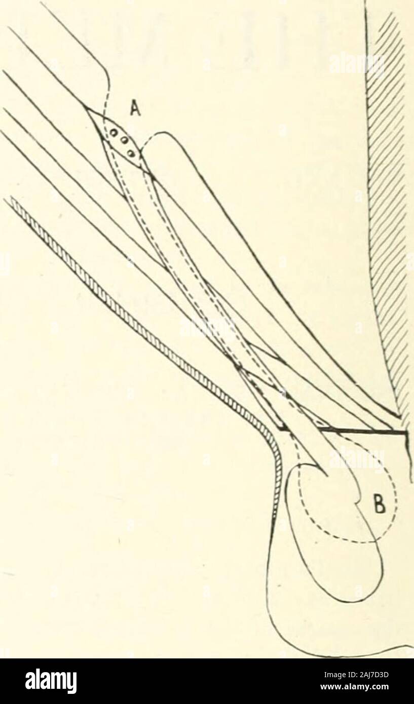 L'âge médicale : un journal bi-mensuel de médecine et chirurgie . Fig. i. à des relations normales. Un super, la peau et l'aponévrose officiel ; B, muscle oblique externe, oblique interne, d'Acdn et transversalismuscles tendon conjoint formant ci-dessous ; je .fascia transversalis ; F, du péritoine ; G, inter-nal anneau abdominal ; H, infundibulum ; I (darkline), l'écusson et la symphyse pubienne ; J, externalabdominal ; anneau K, cavité péritonéale ; I., rec-tus abdominis muscle ; M, le scrotum. Fig. 2.-sac herniaire en saillie. Coupematérialise (en pointillés, péritoine formant sa-nial sac). Un sac de cou, entrant dans internalring ; B, sac à Banque D'Images