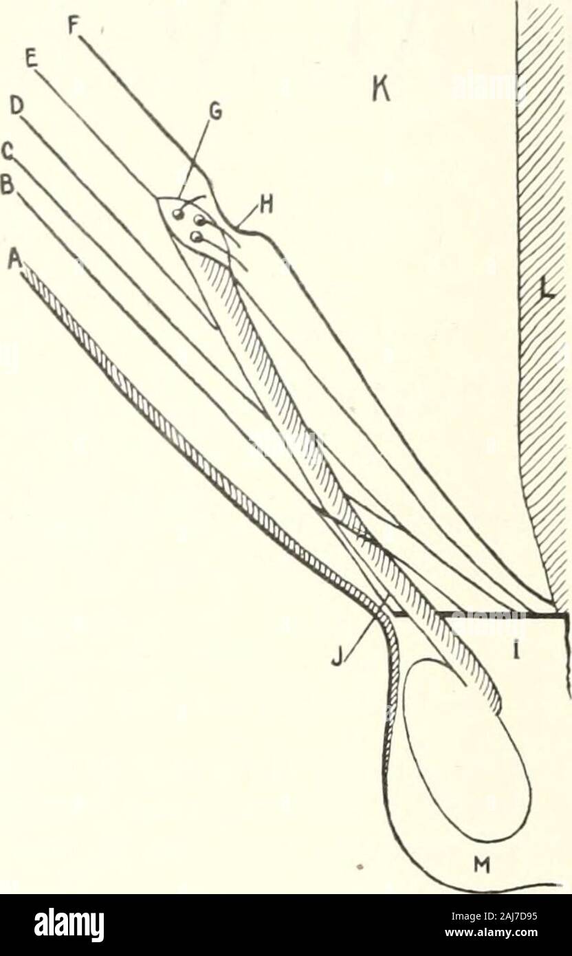 L'âge médicale : un journal bi-mensuel de médecine et chirurgie . ge, et peut à bon droit être classés avec la face ventrale, herniae pourla viscus dépasse directement à travers la paroi abdominale derrière le externalring. La position normale de l'cordon spermatique, les ouvertures par lesquelles il passe, et les différentes couches de tissu dans cette région sont présentés à la Fig. 1,alors que la Fig. 2 montre le péritoine s'étendant vers le bas à travers l'anneau interne,canal inguinal, la bague externe, et dans le scrotum, formant le orpouch sac herniaire. Les méthodes coopératives plus modernes pour un traitement radical ont péché intopractice Banque D'Images