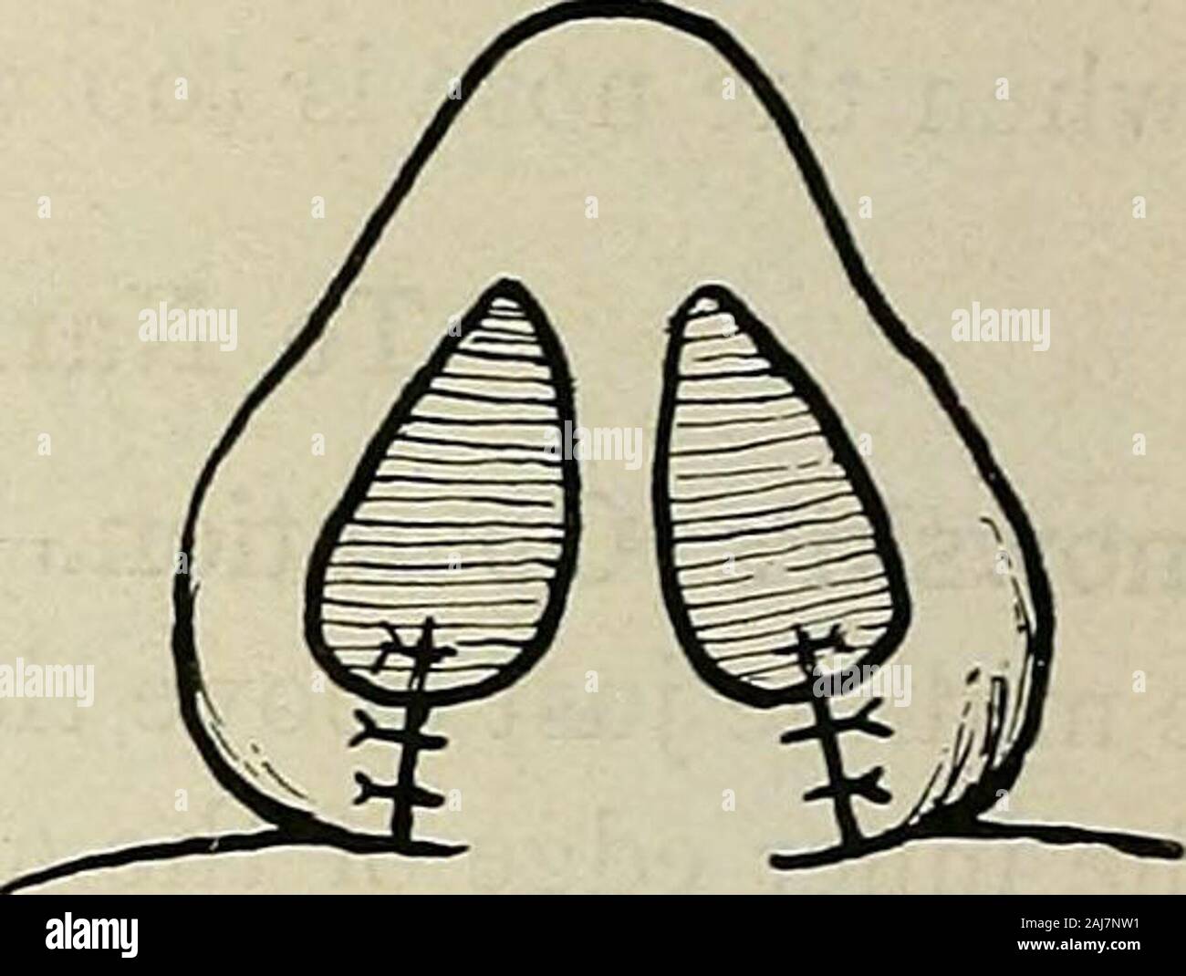 La chirurgie plastique ; ses principes et pratiques . Fig. 541. Pour réduire la base du nez (Heimat).-i. L'obscurité et les lignes en pointillé indiquent les incisions faites pour la dépose de tissu. 2. Le edgesapproximated. g&gt ; &Lt ;^ Banque D'Images